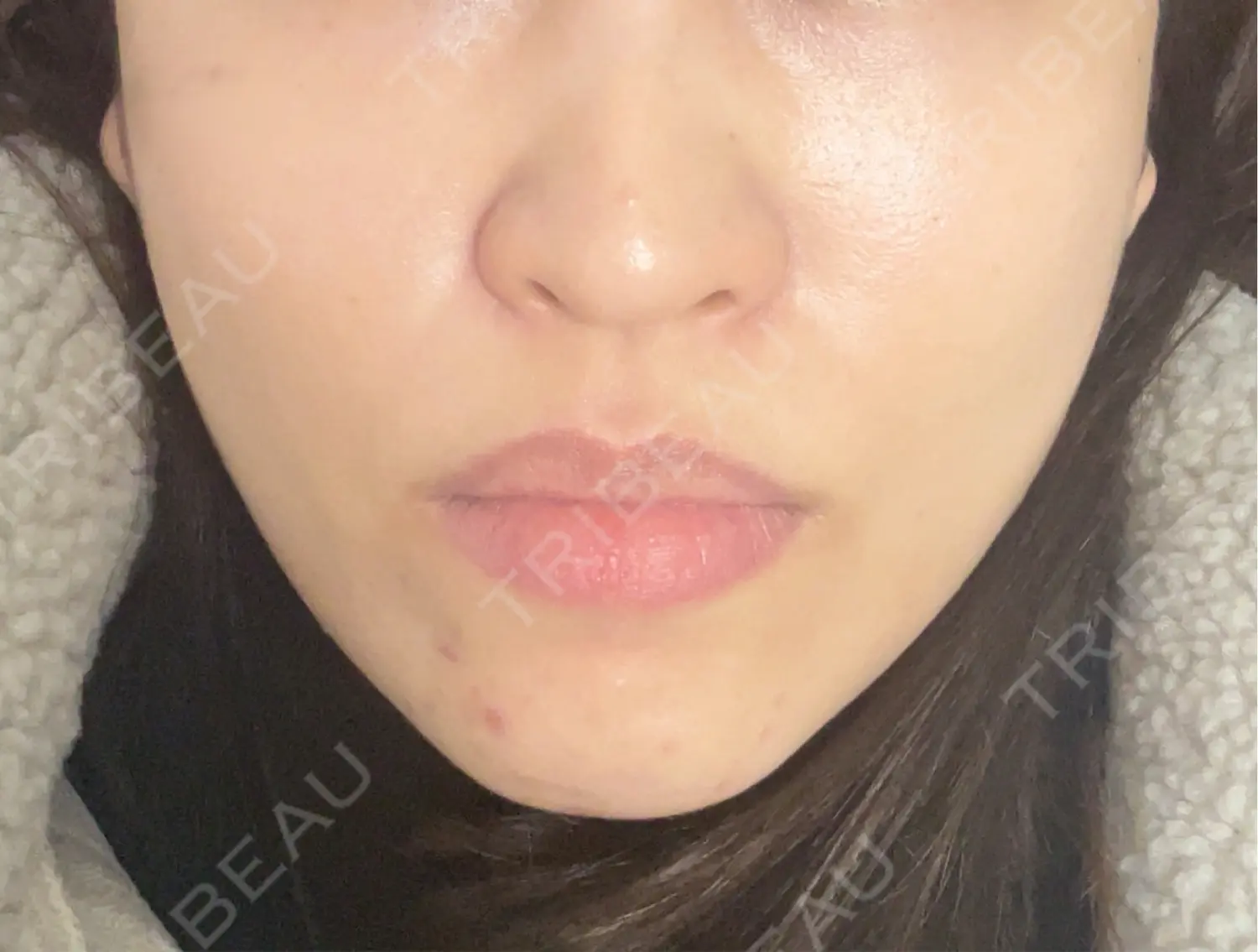 施術後の写真