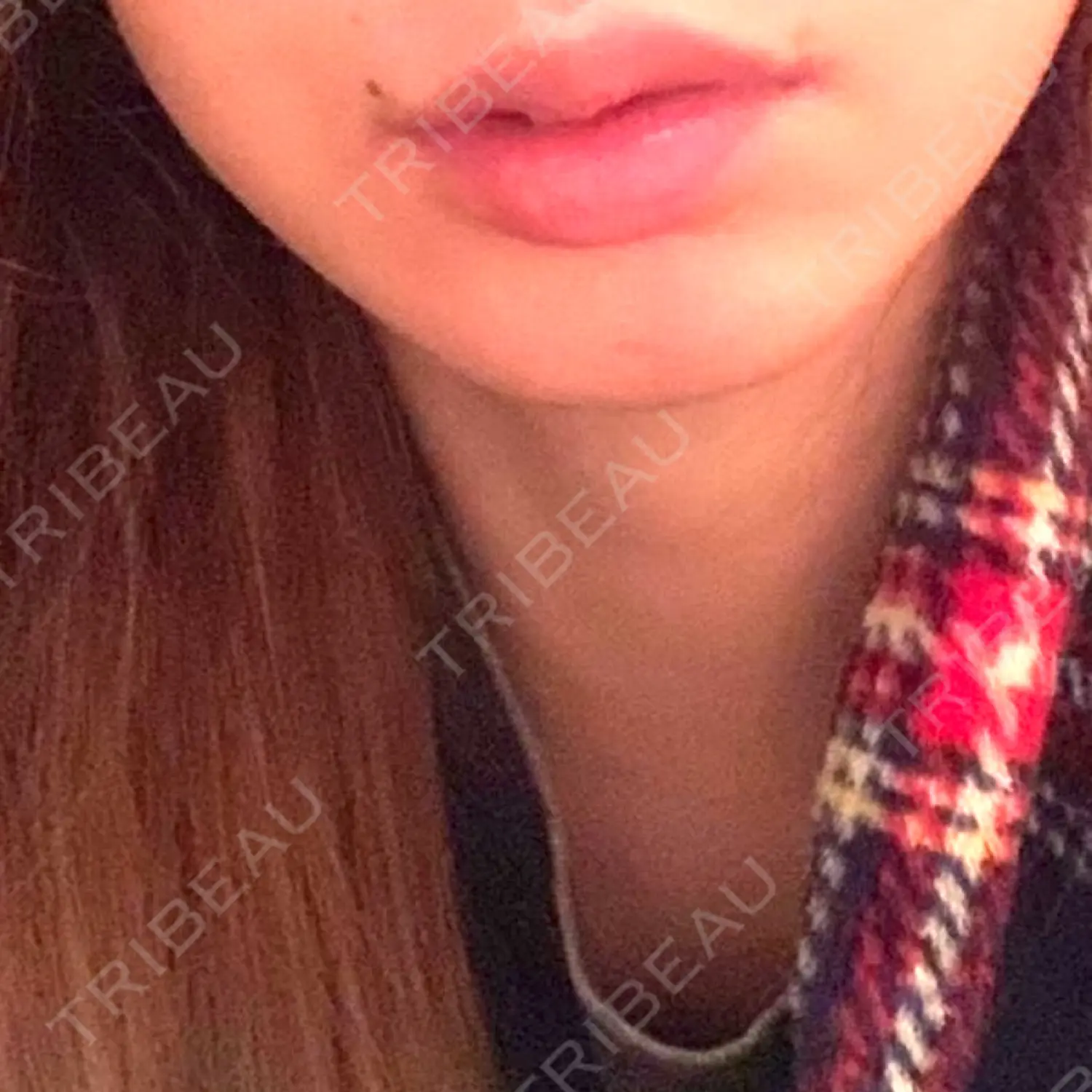 施術後の写真