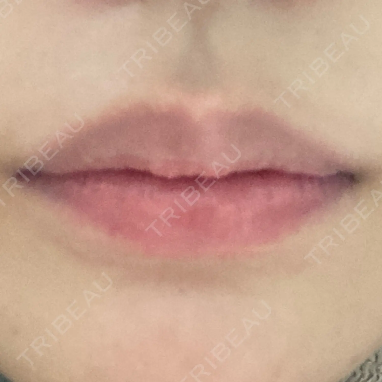 施術後の写真