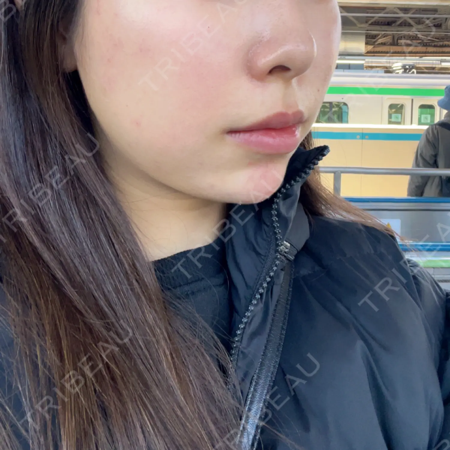 施術後の写真
