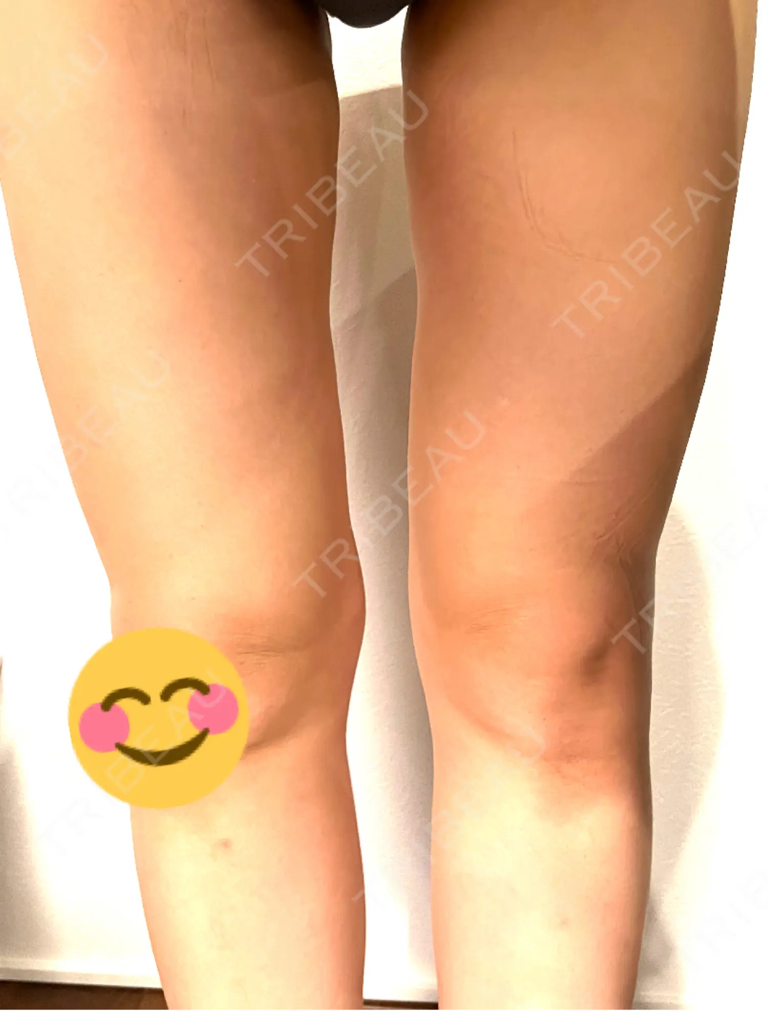 施術後の写真