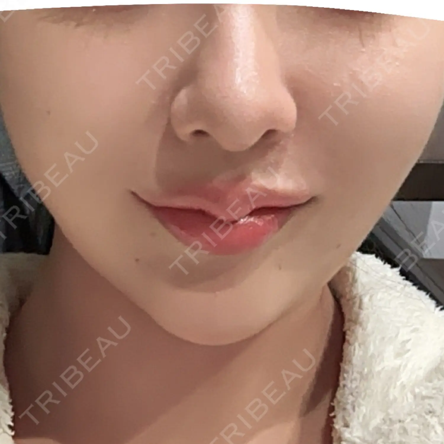 施術後の写真