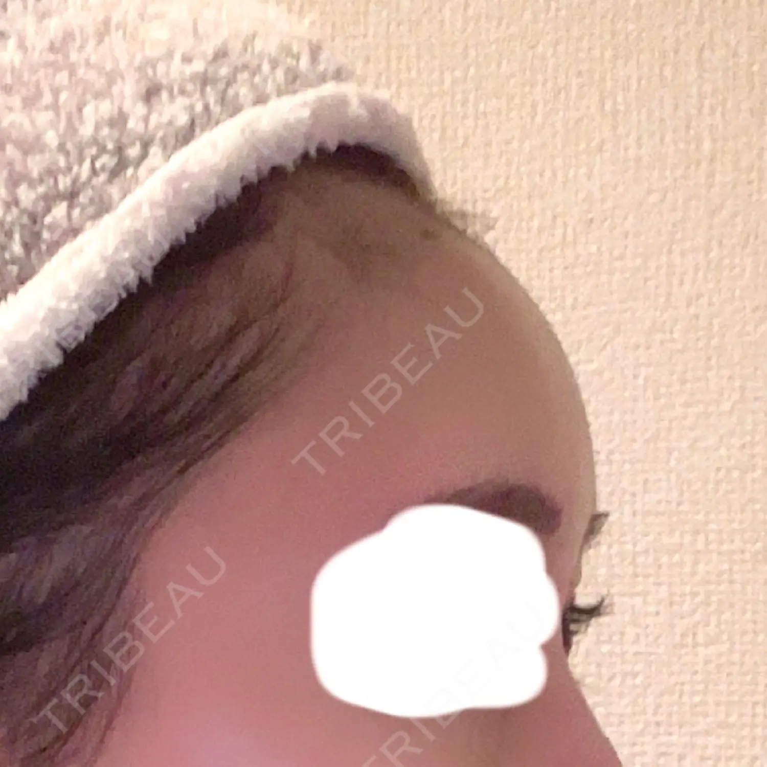 施術後の写真