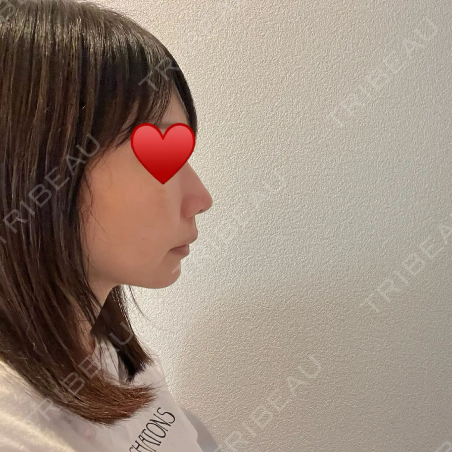 施術後の写真