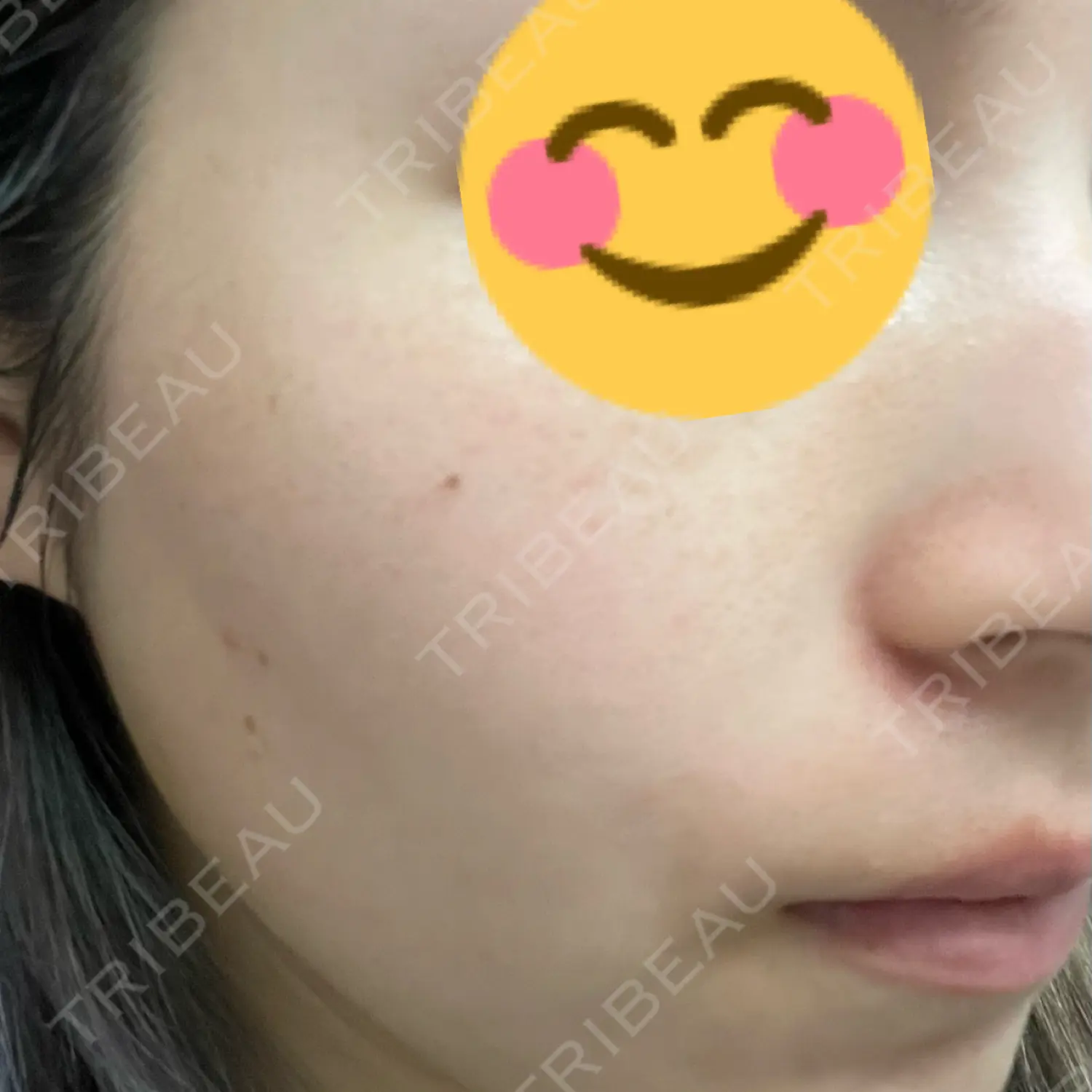 施術後の写真