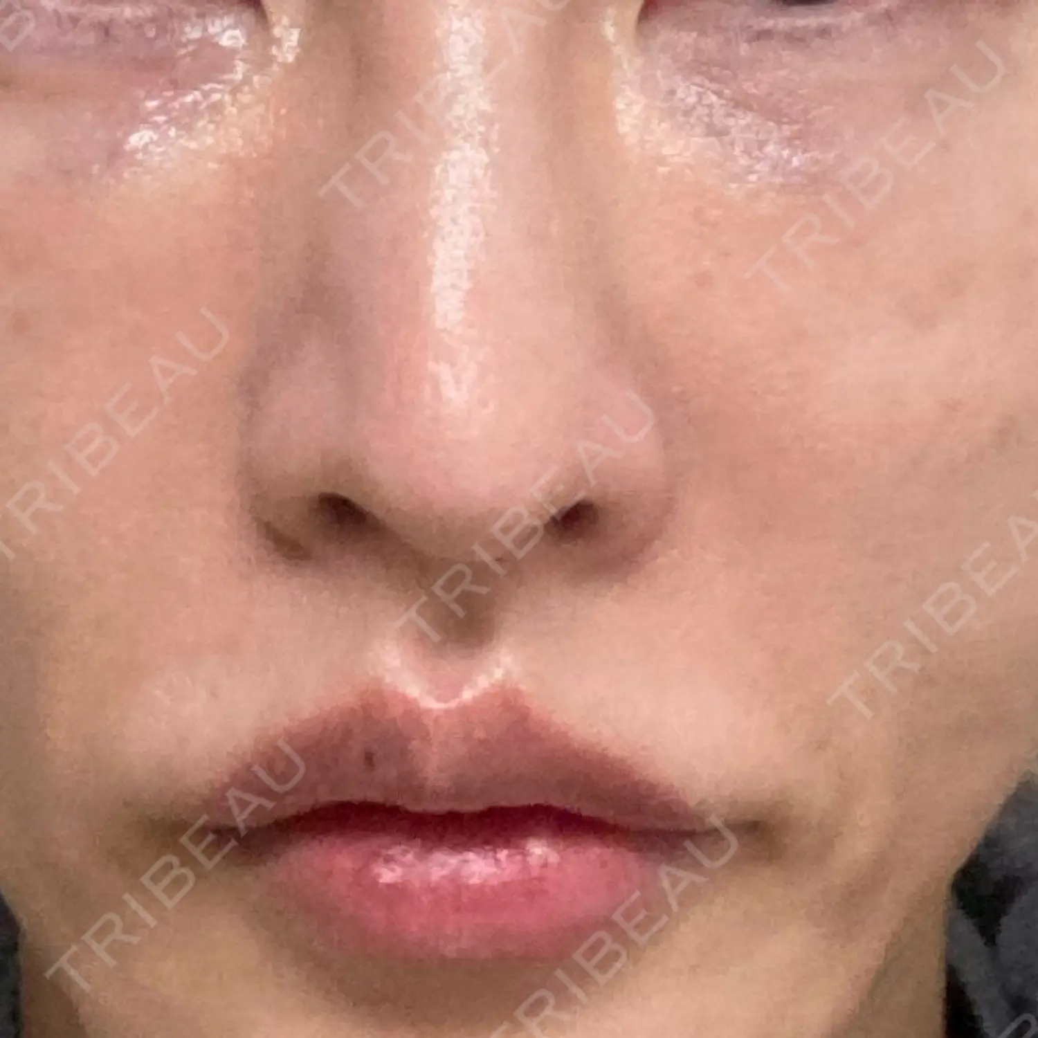 施術後の写真