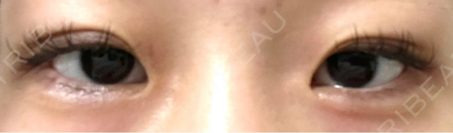 施術後の写真
