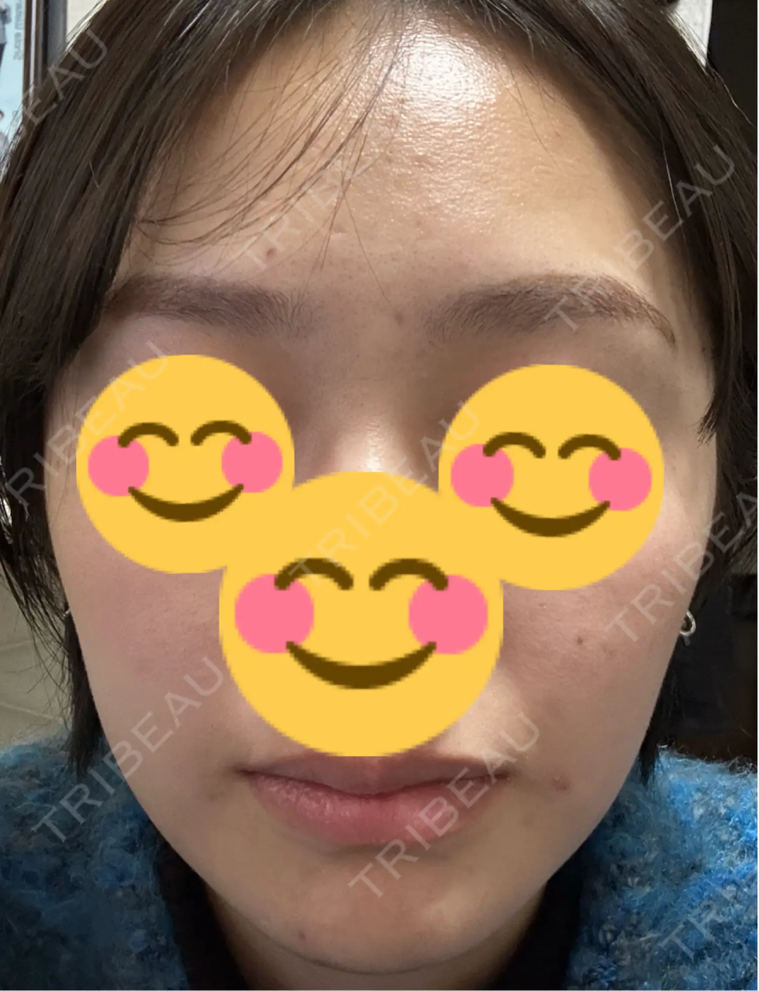 施術後の写真