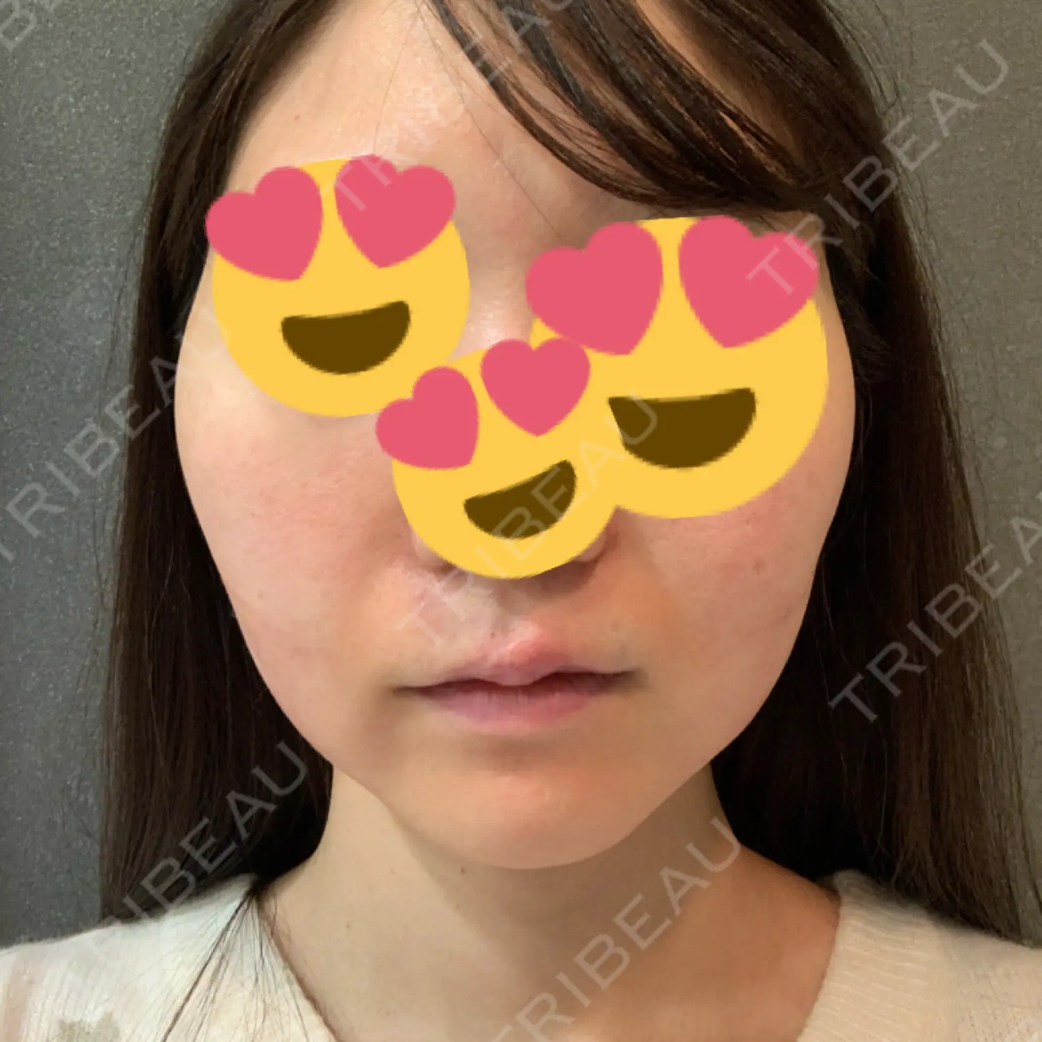 施術後の写真