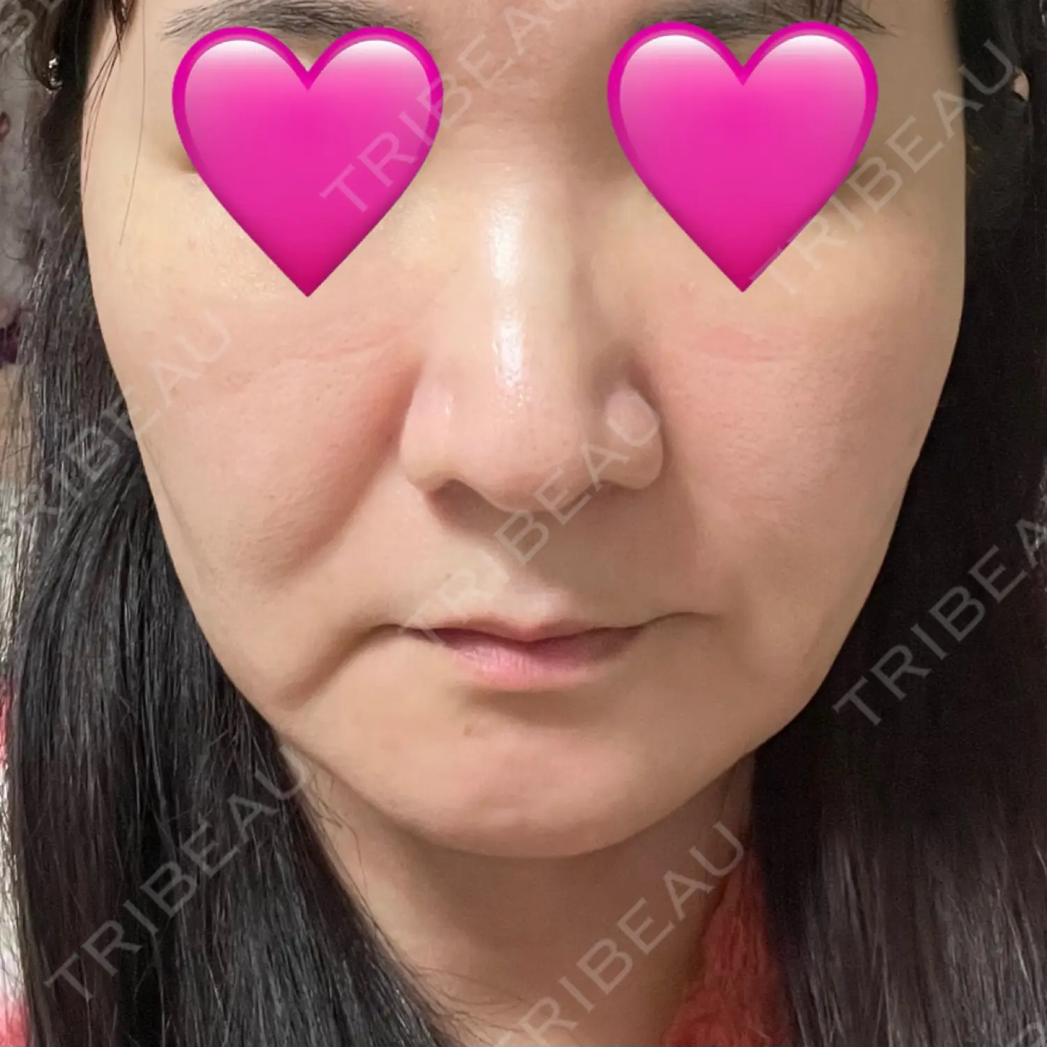 施術後の写真