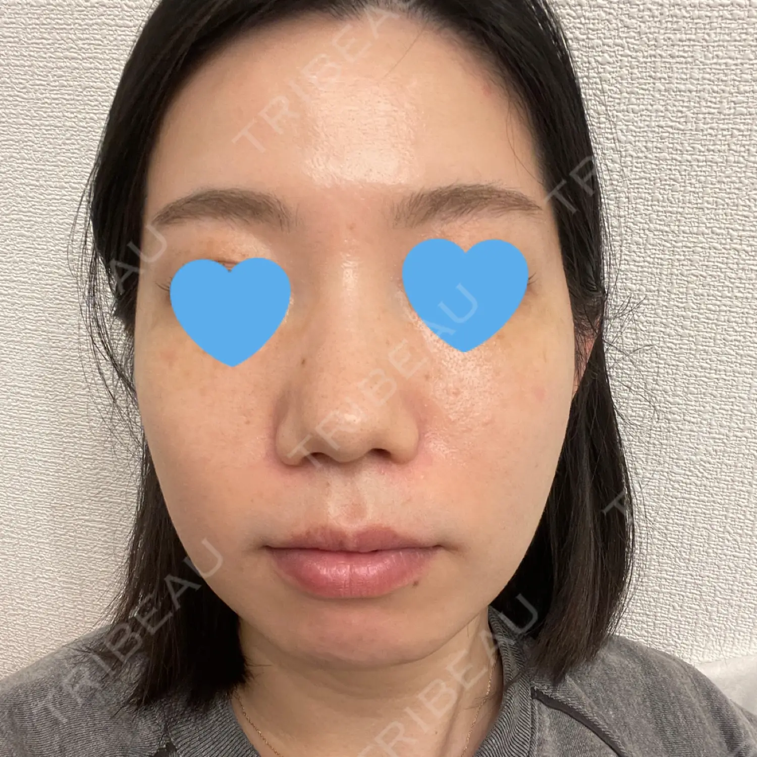 施術後の写真