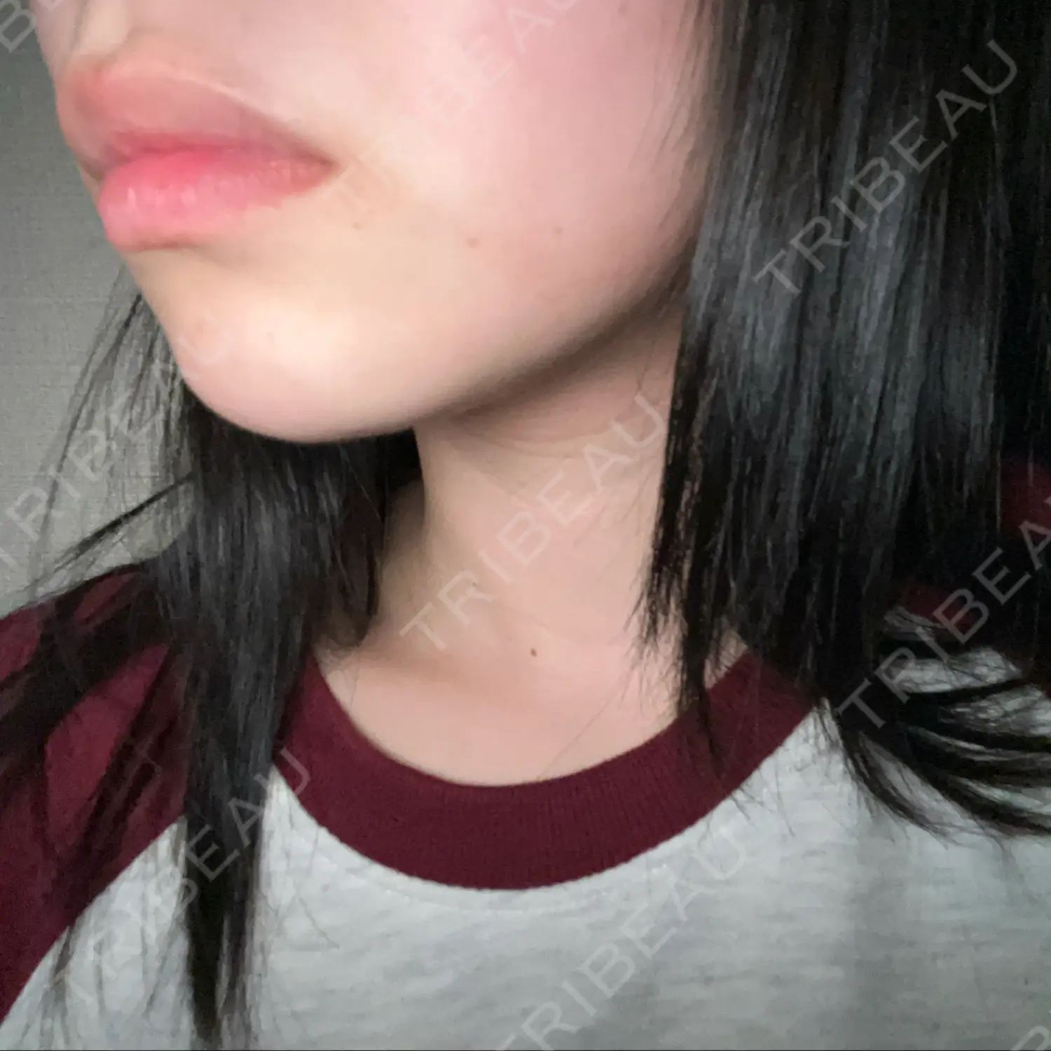 施術後の写真