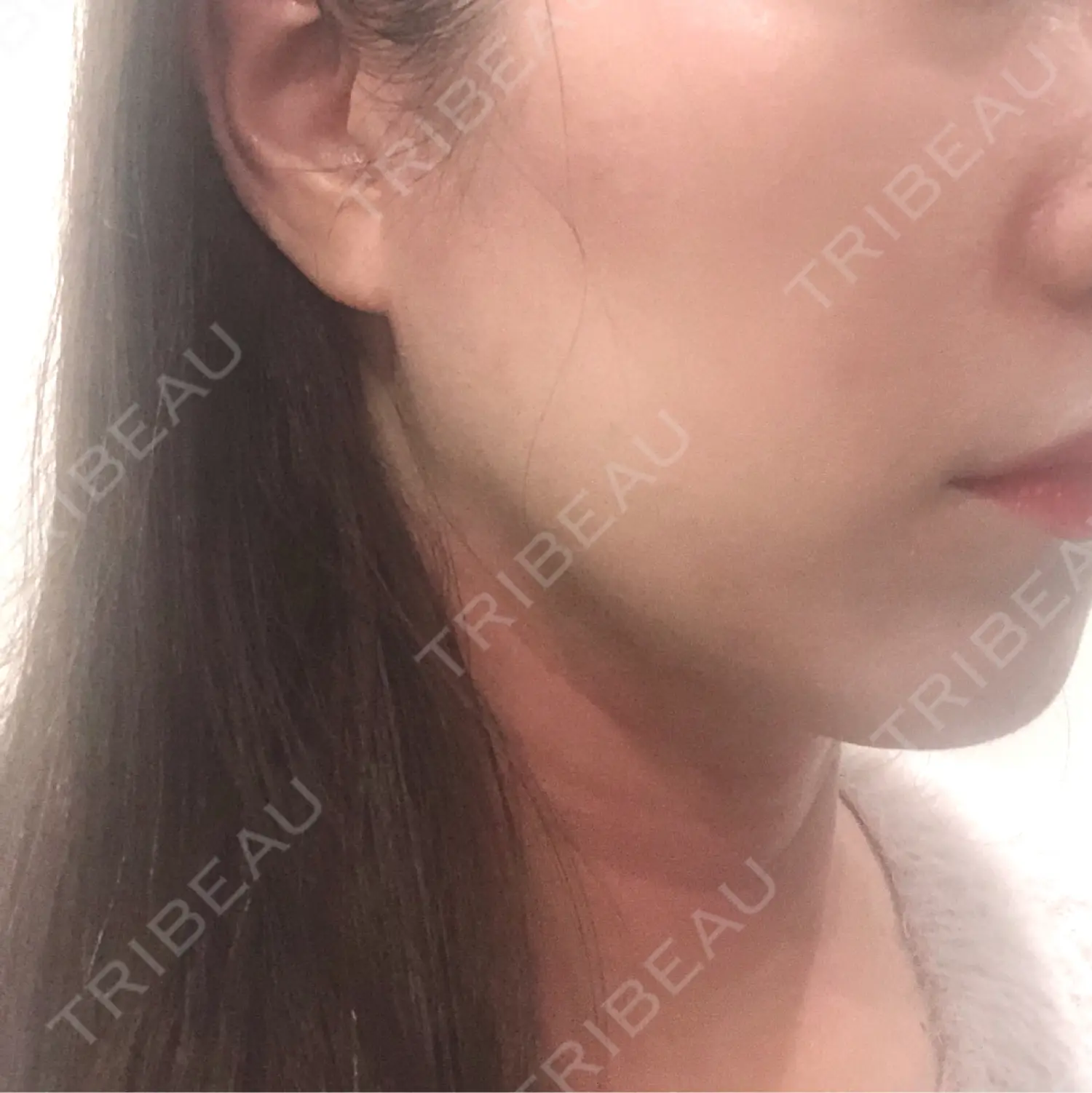施術後の写真