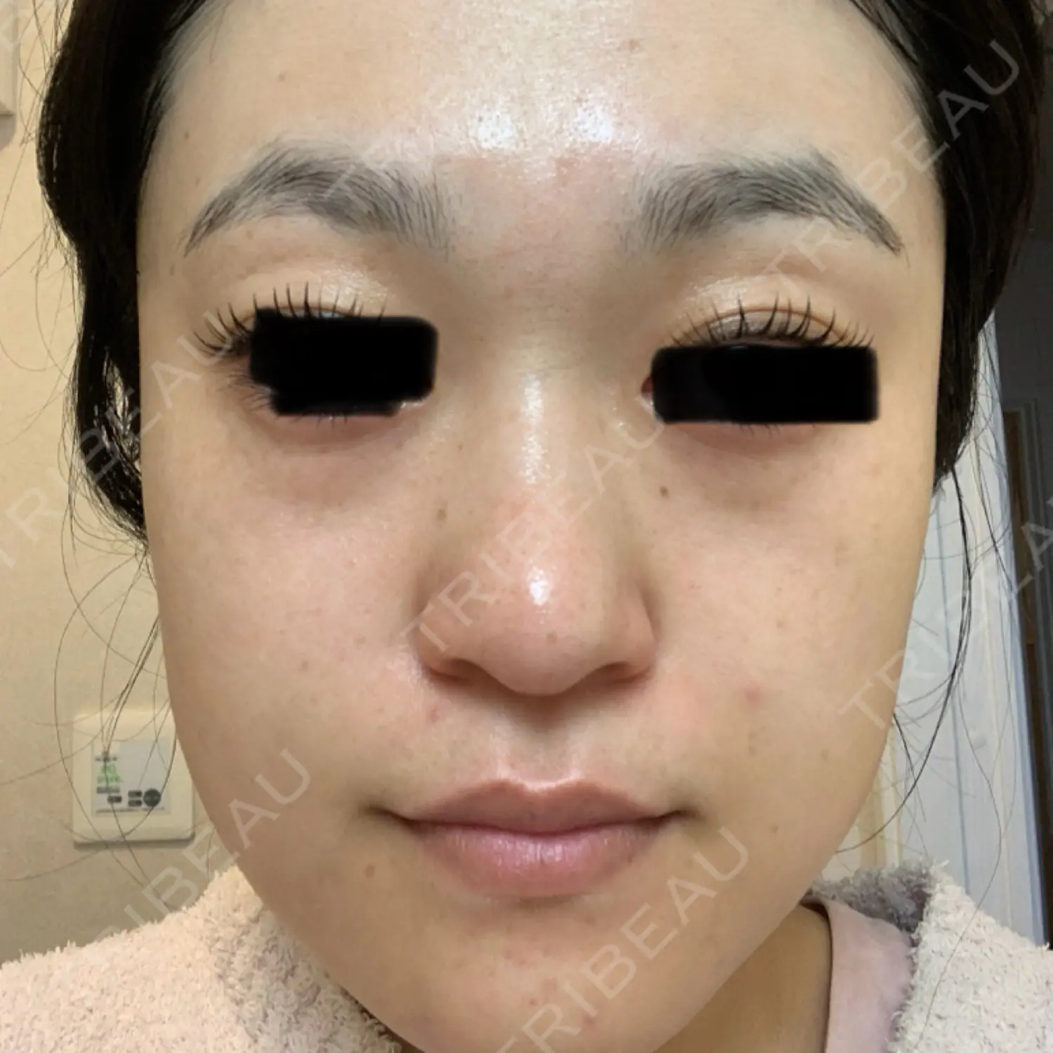 施術後の写真