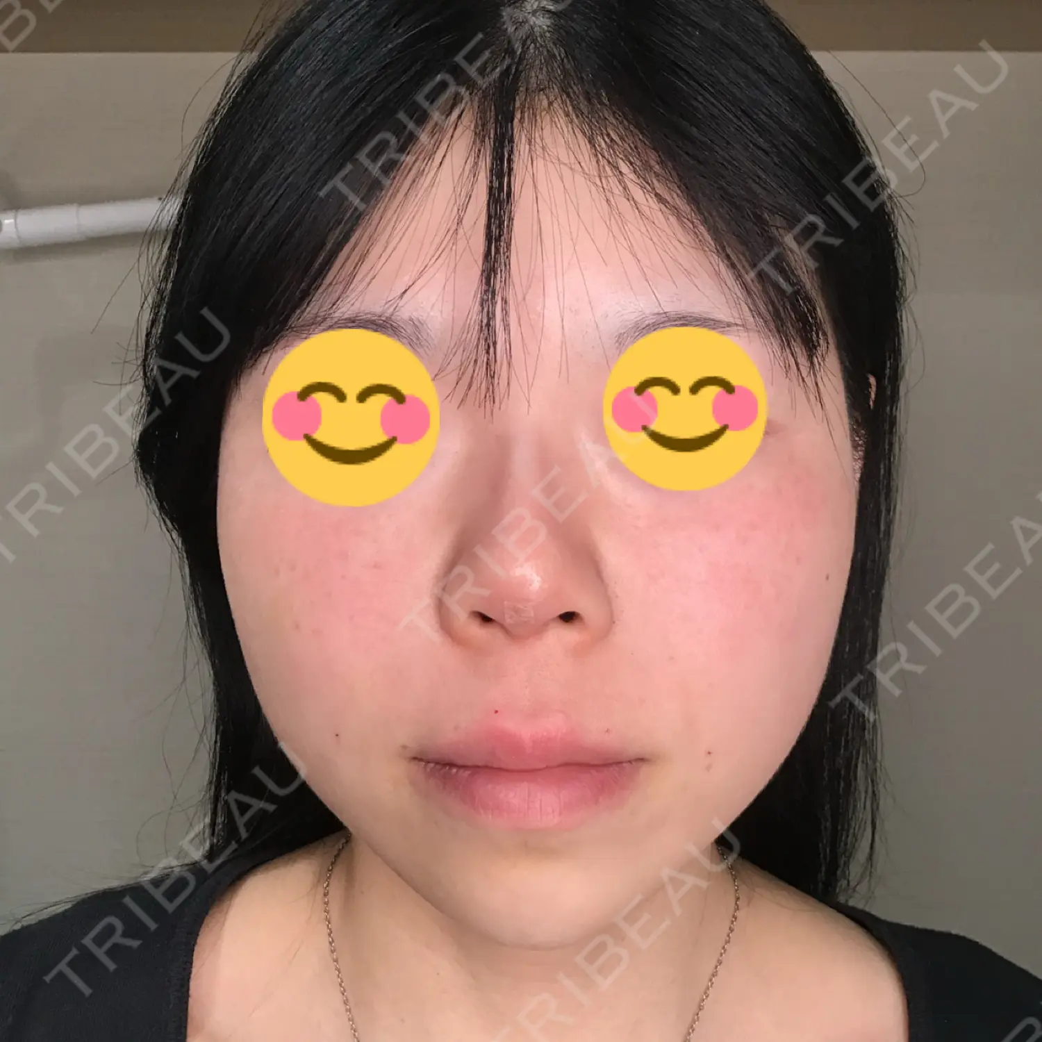 施術後の写真
