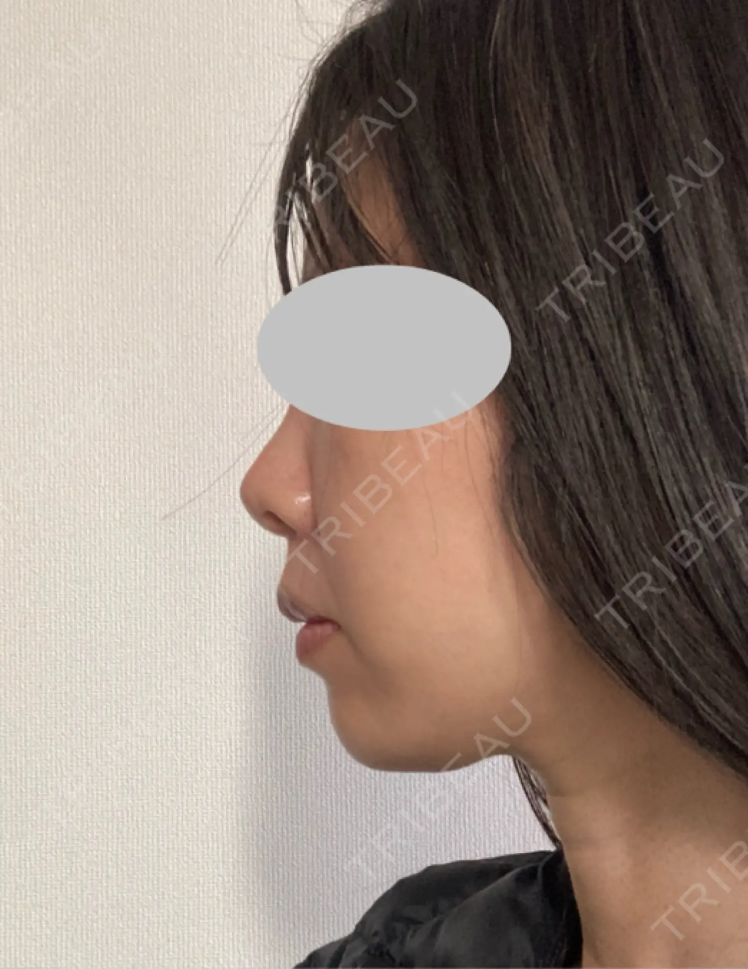 施術後の写真