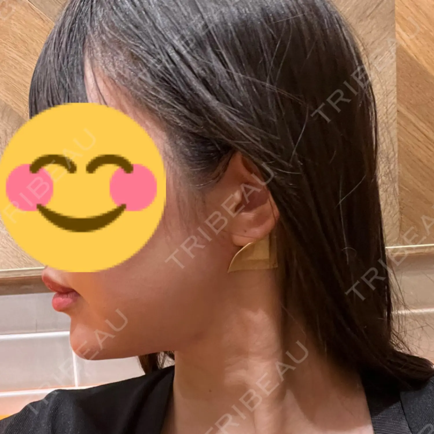 施術後の写真