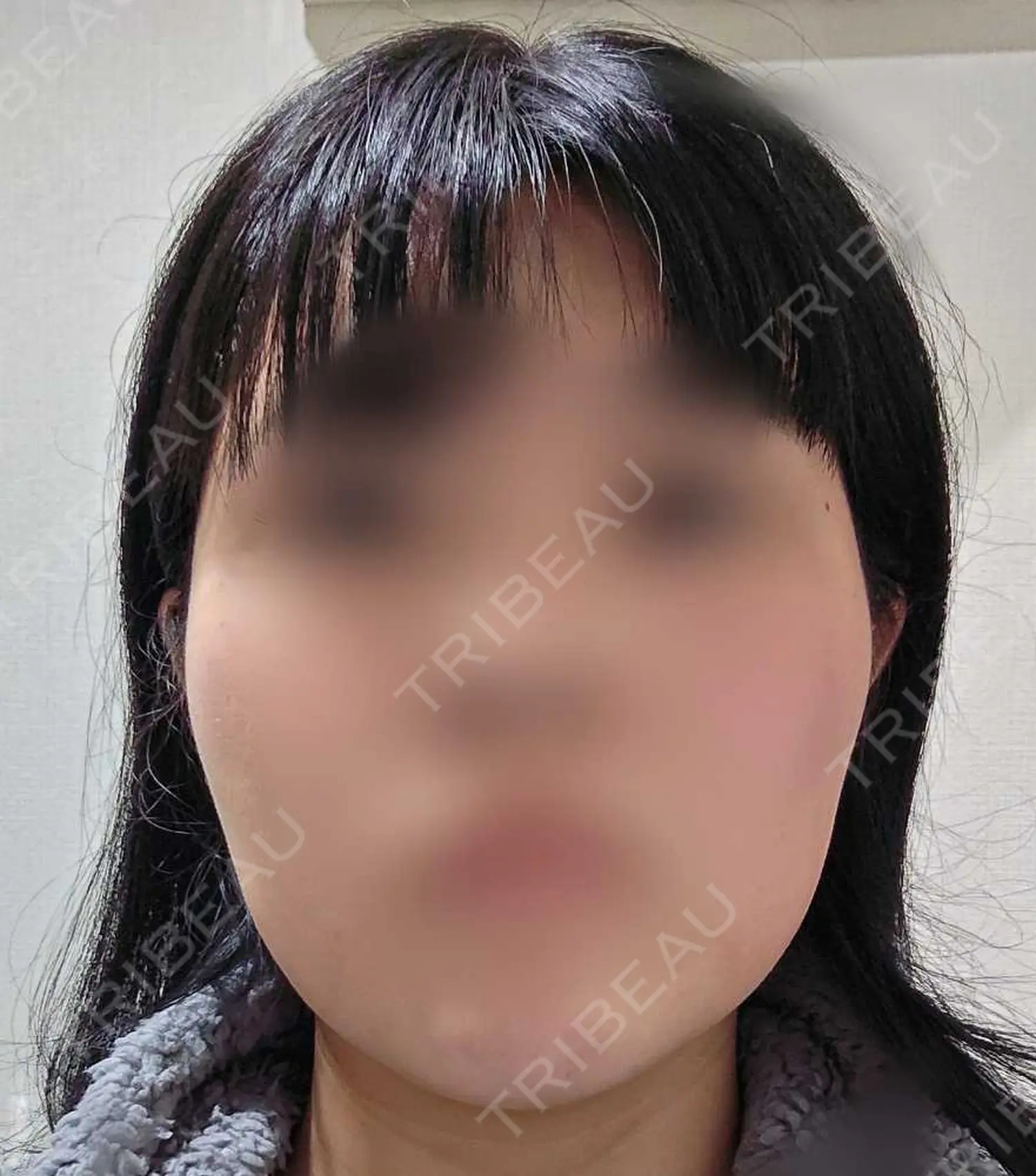 施術後の写真