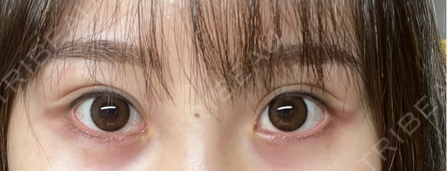 施術後の写真