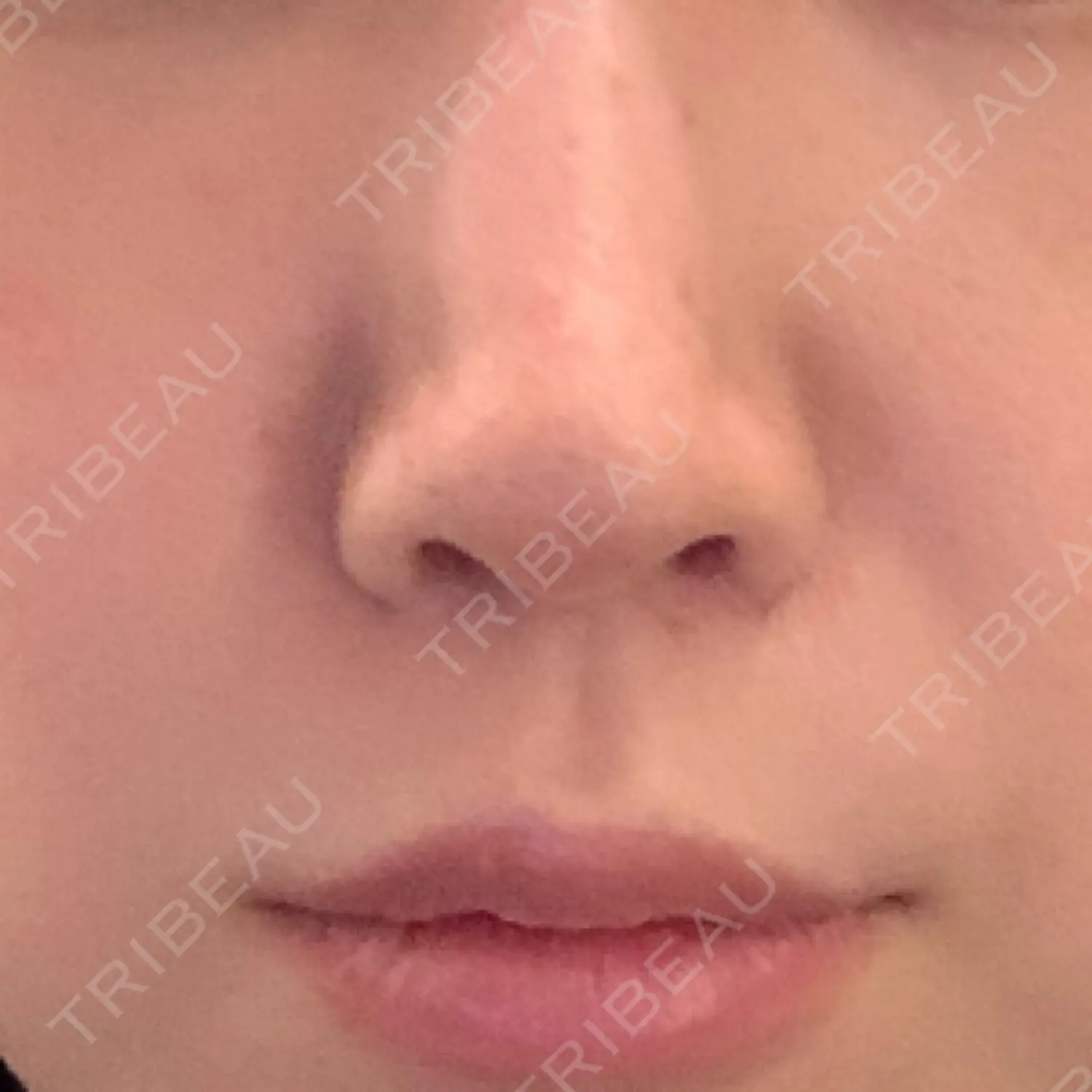 施術後の写真