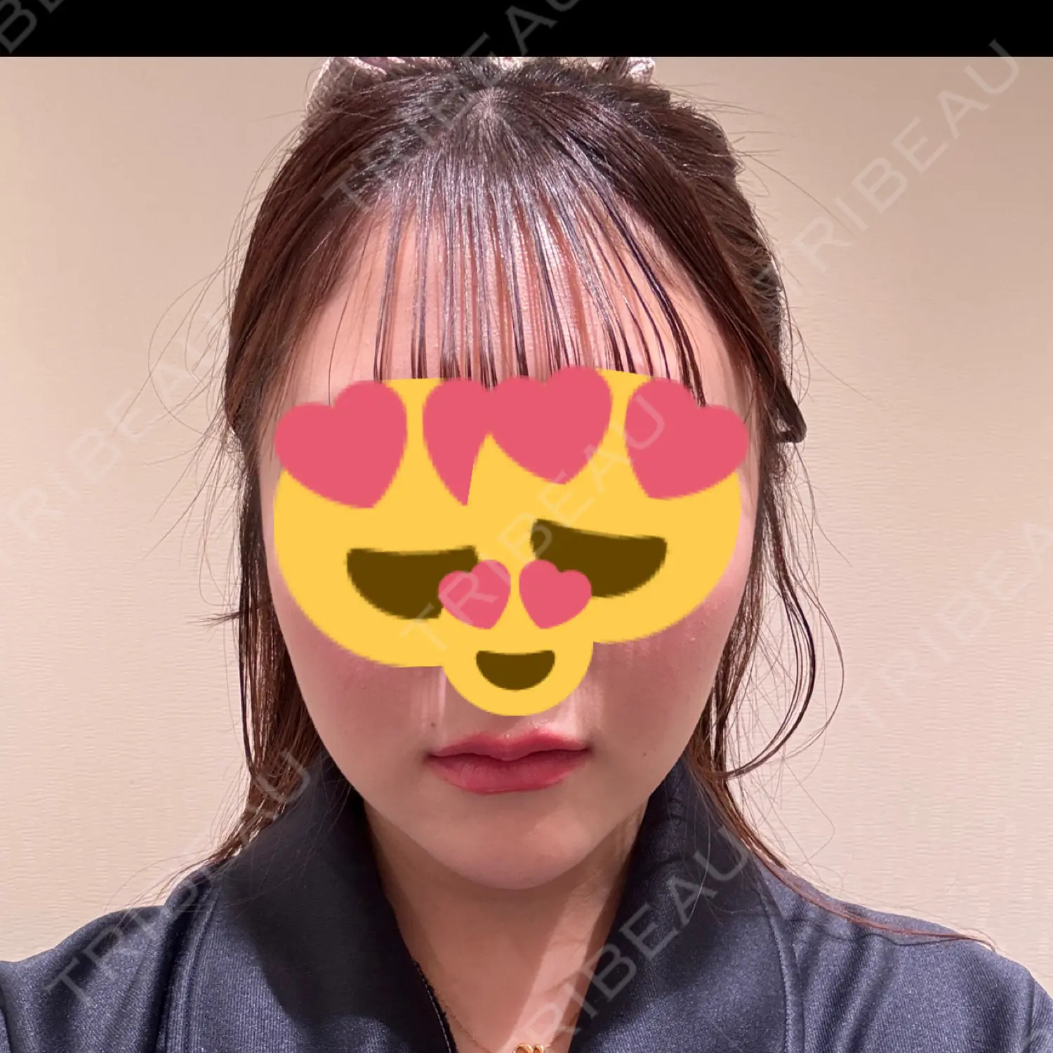 施術後の写真