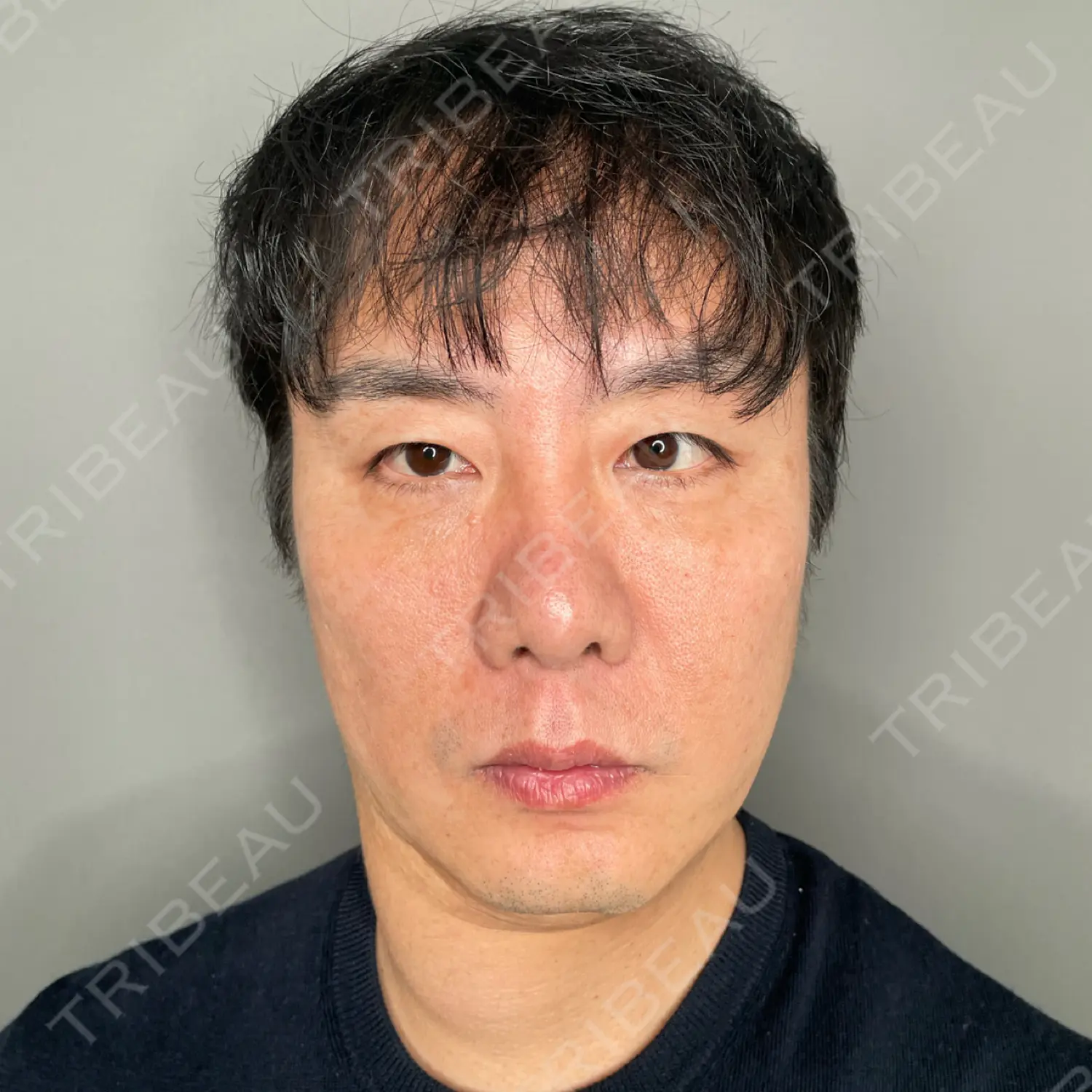 施術後の写真