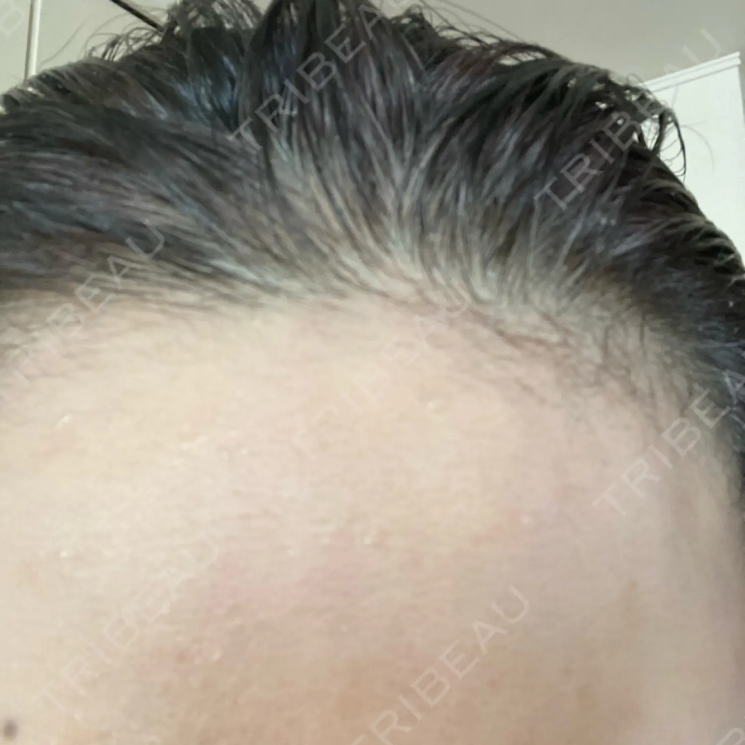 施術後の写真