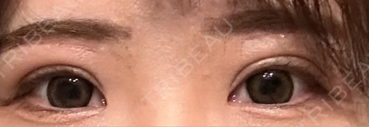 施術後の写真