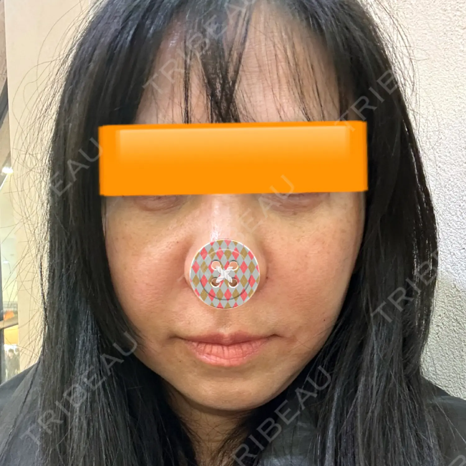 施術後の写真
