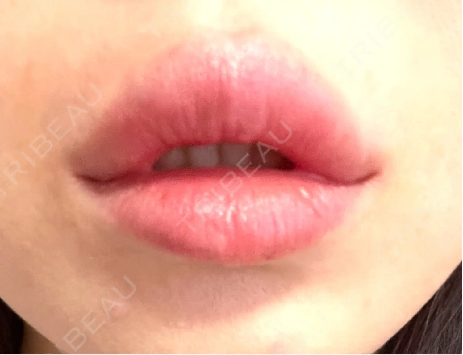 施術後の写真