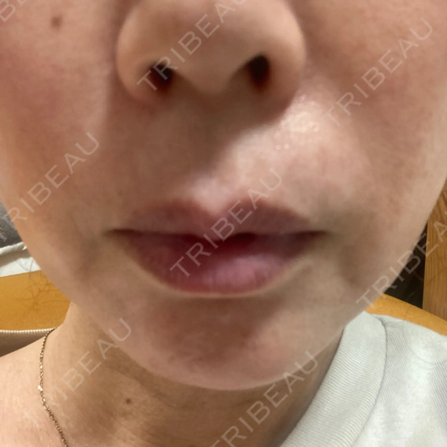 施術後の写真