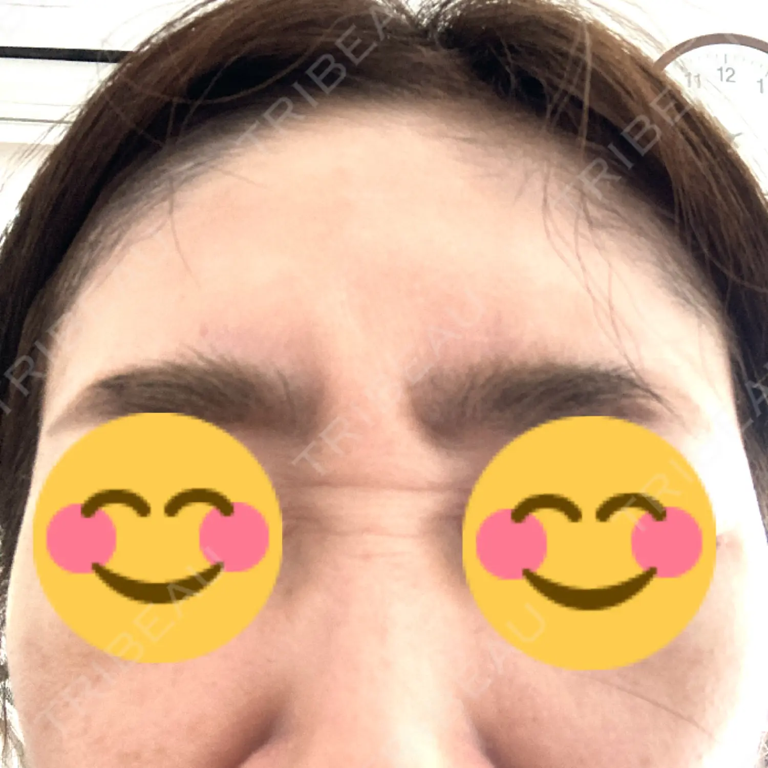 施術後の写真