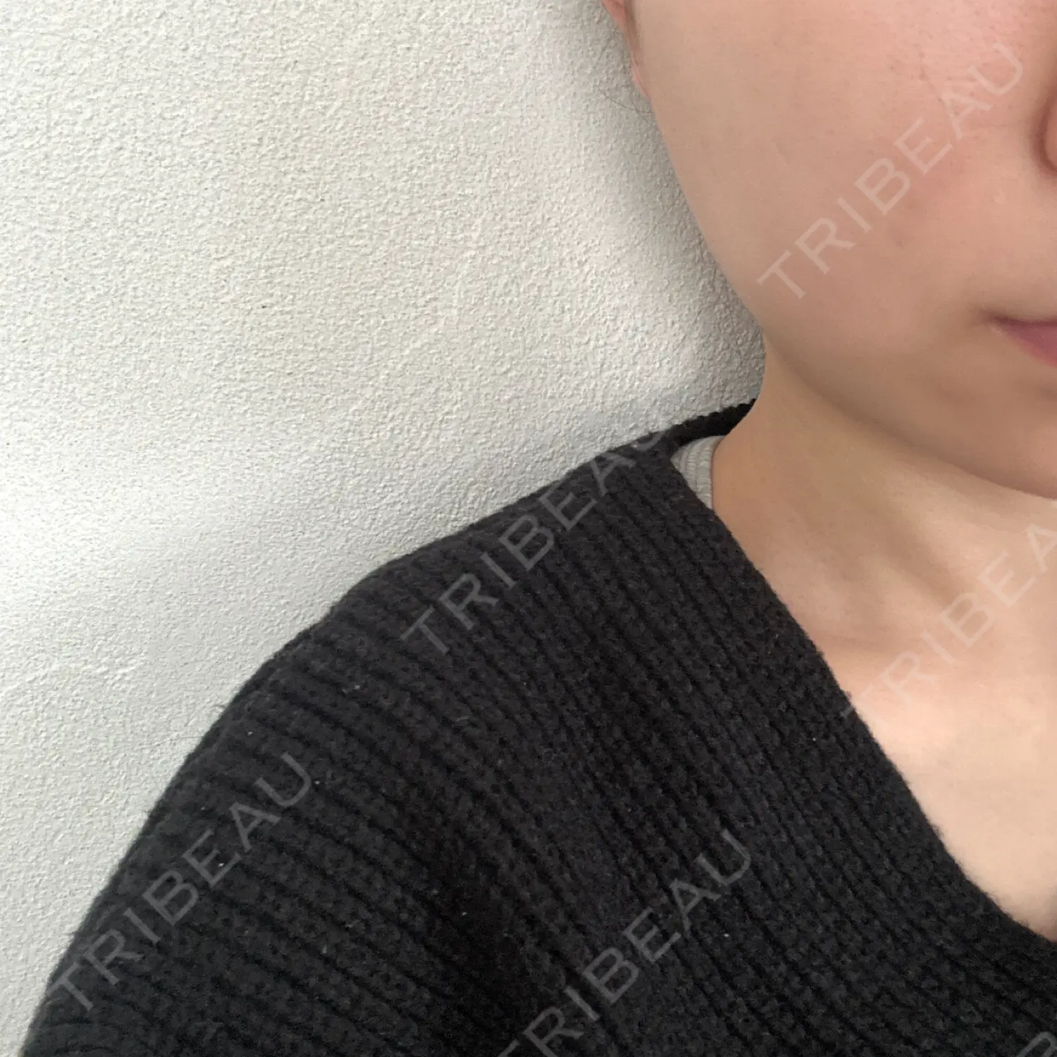 施術後の写真