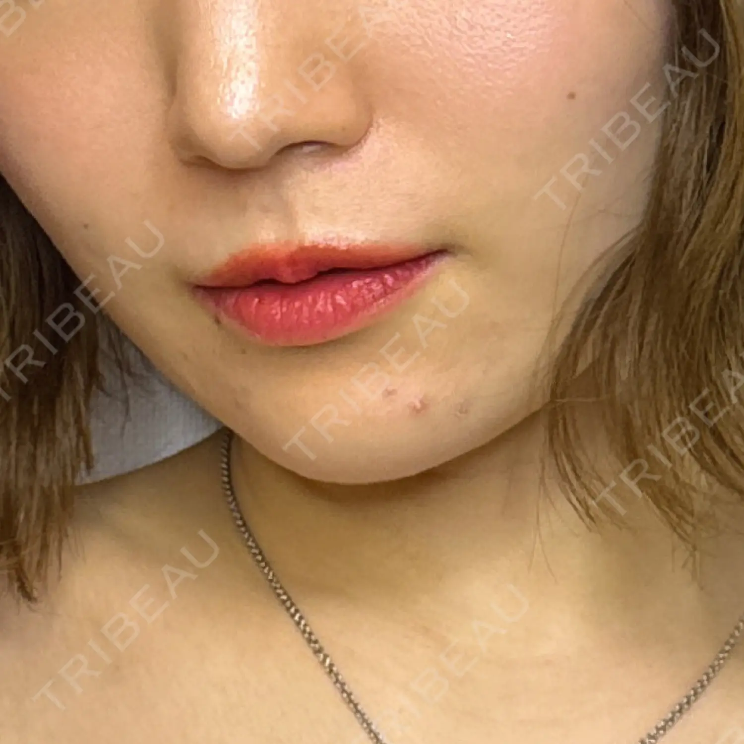 施術後の写真