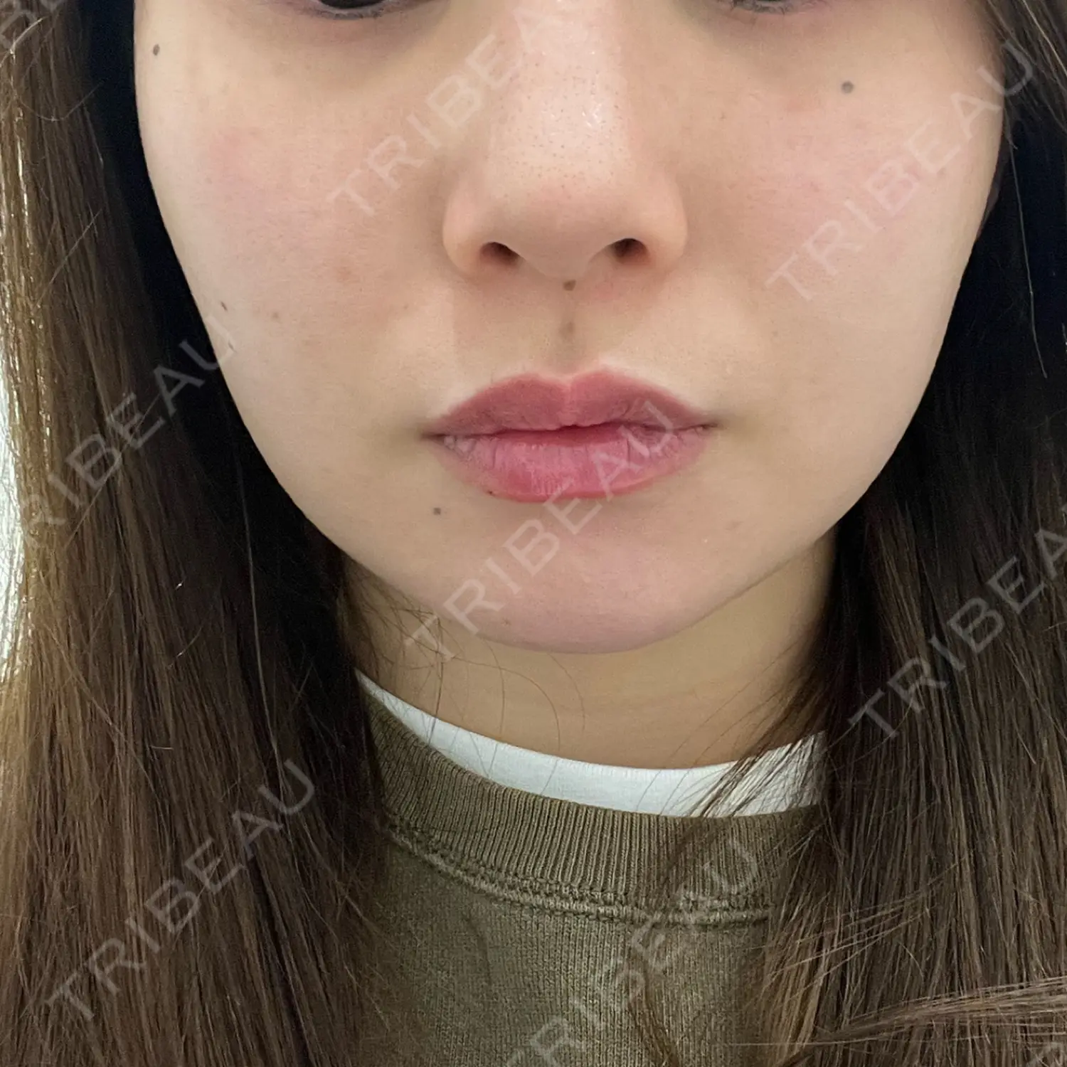 施術後の写真