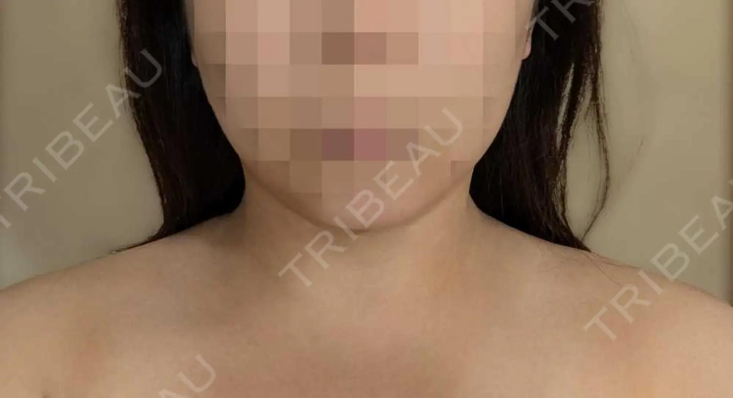 施術後の写真