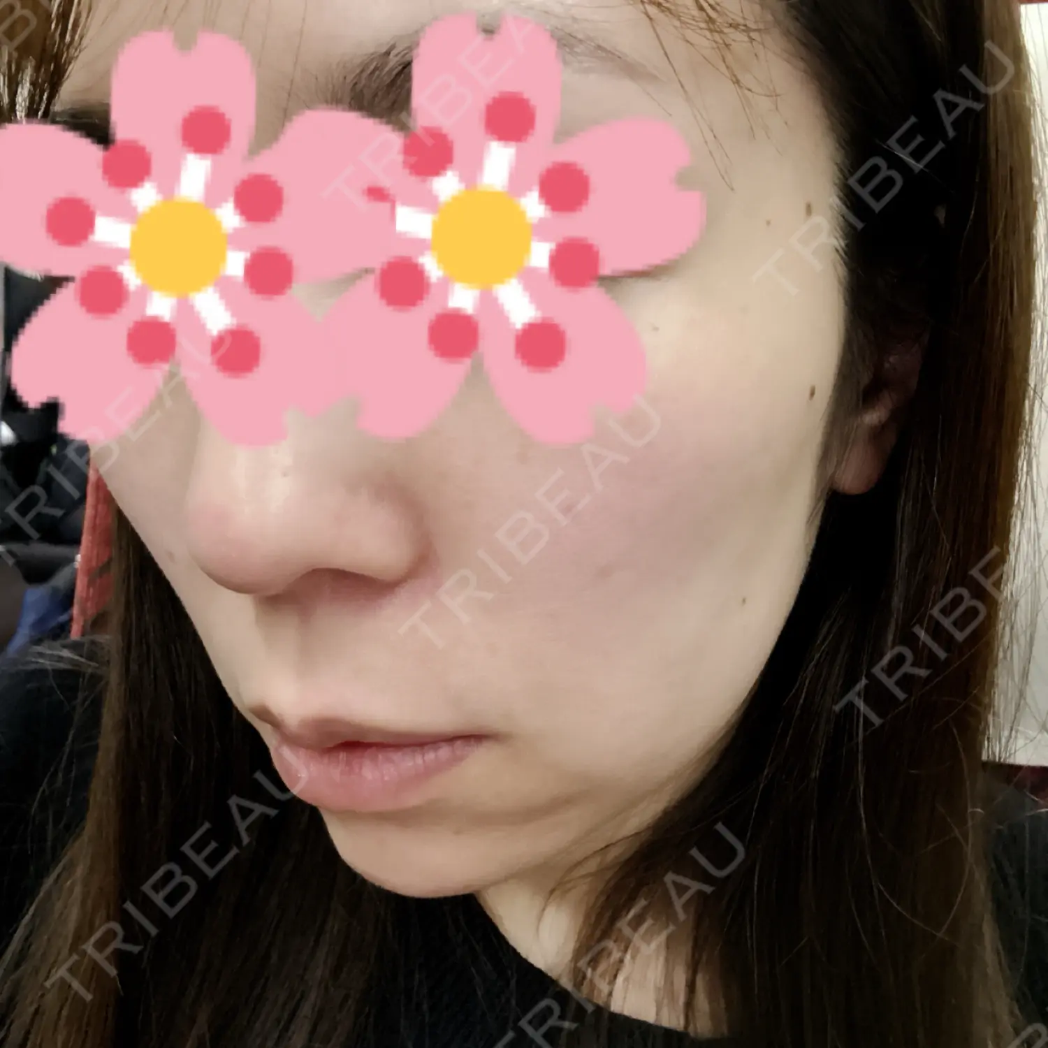 施術後の写真
