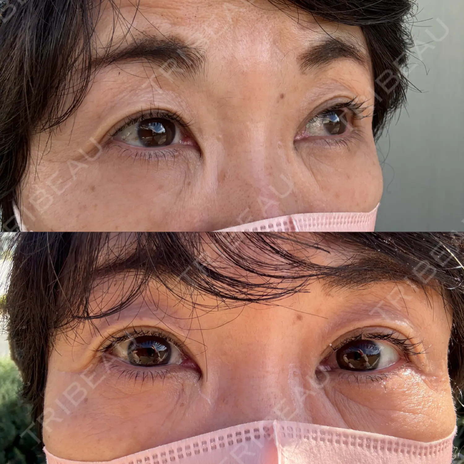 施術後の写真