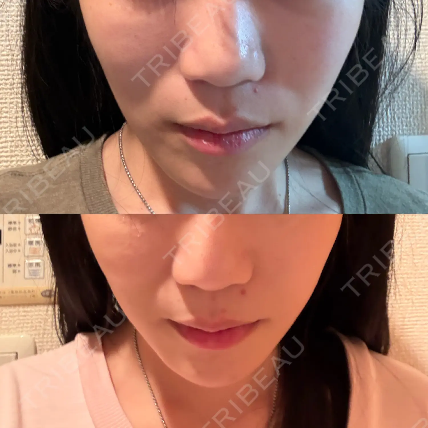 施術後の写真