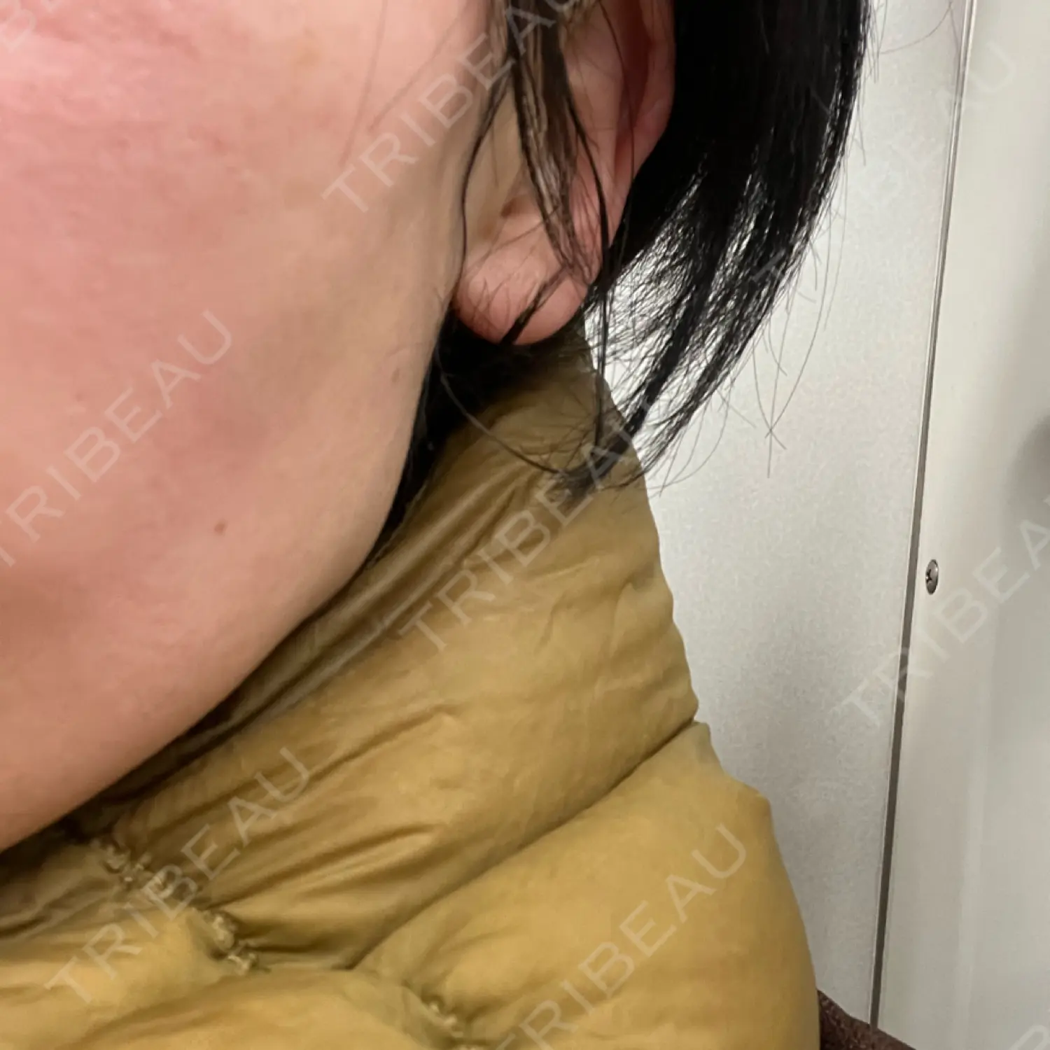 施術後の写真