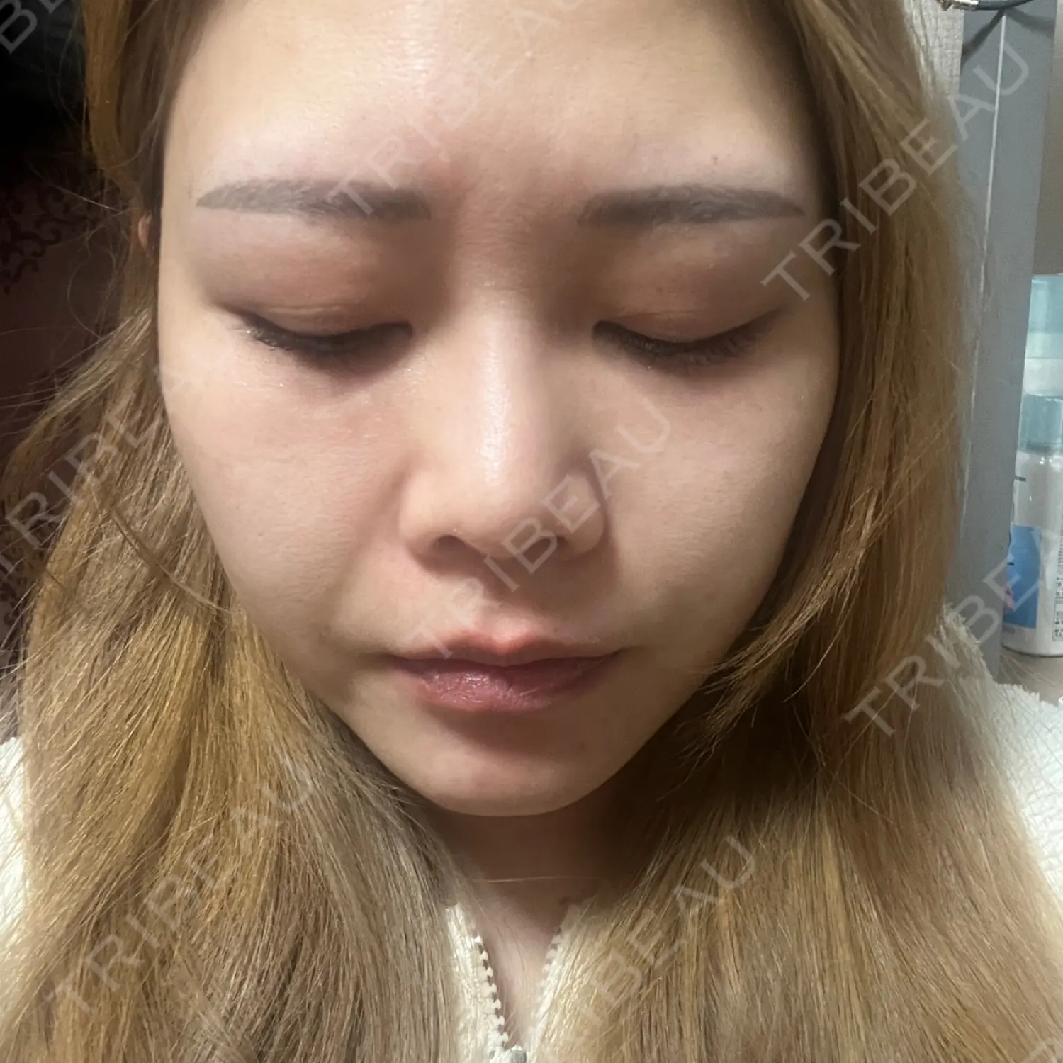 施術後の写真