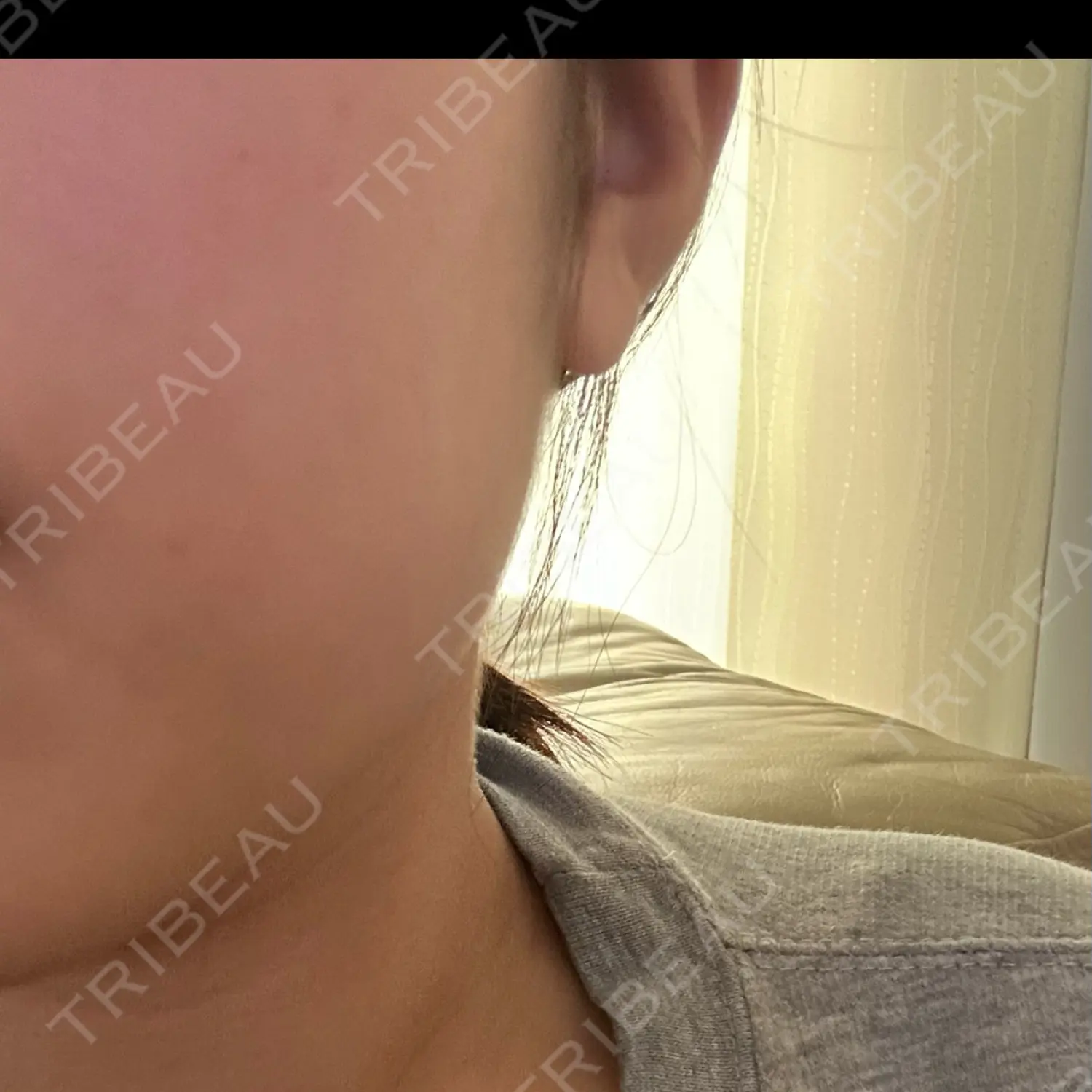 施術後の写真