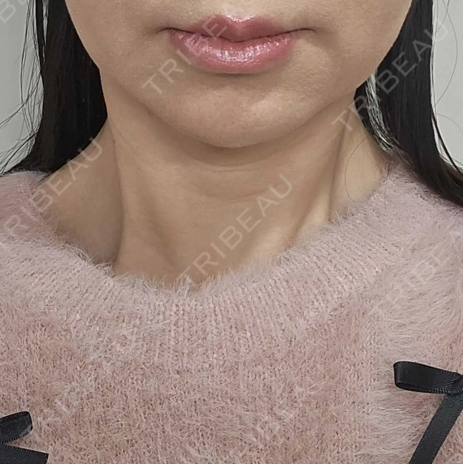 施術後の写真