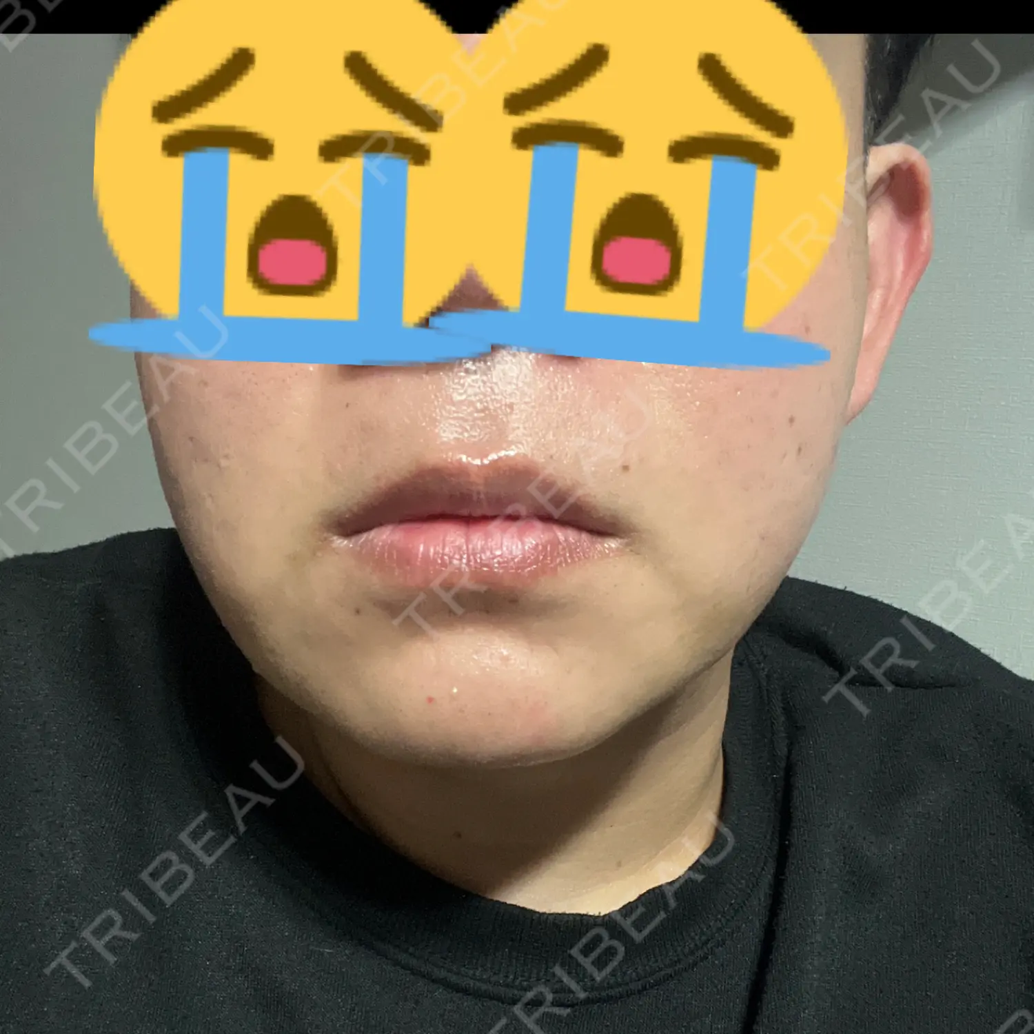 施術後の写真