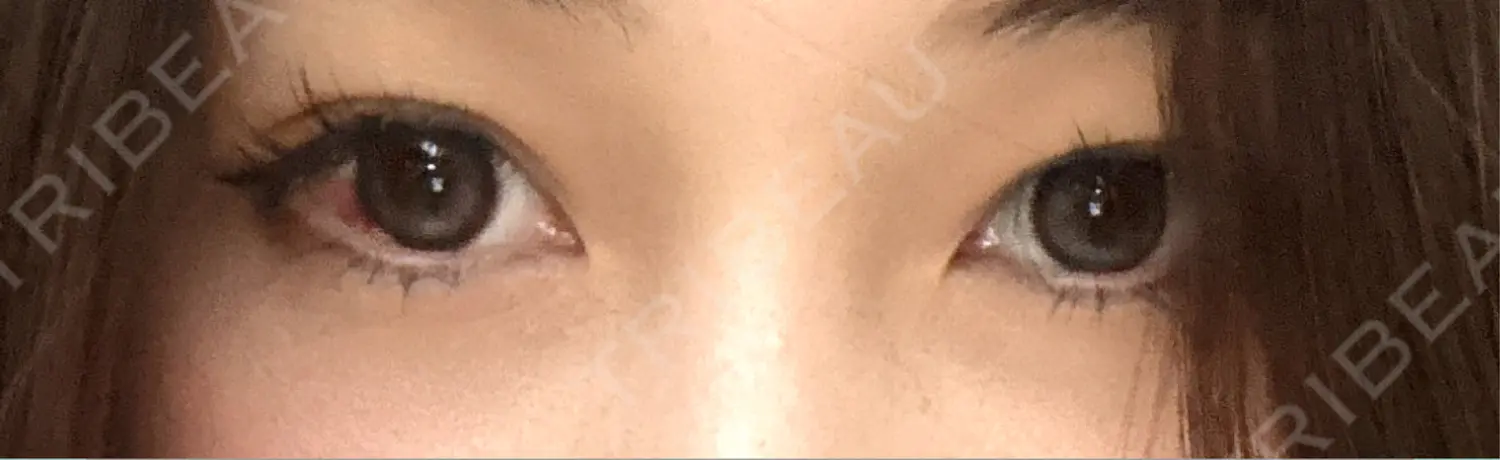施術後の写真