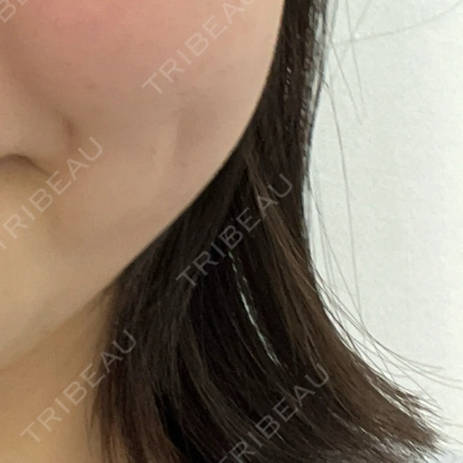 施術後の写真