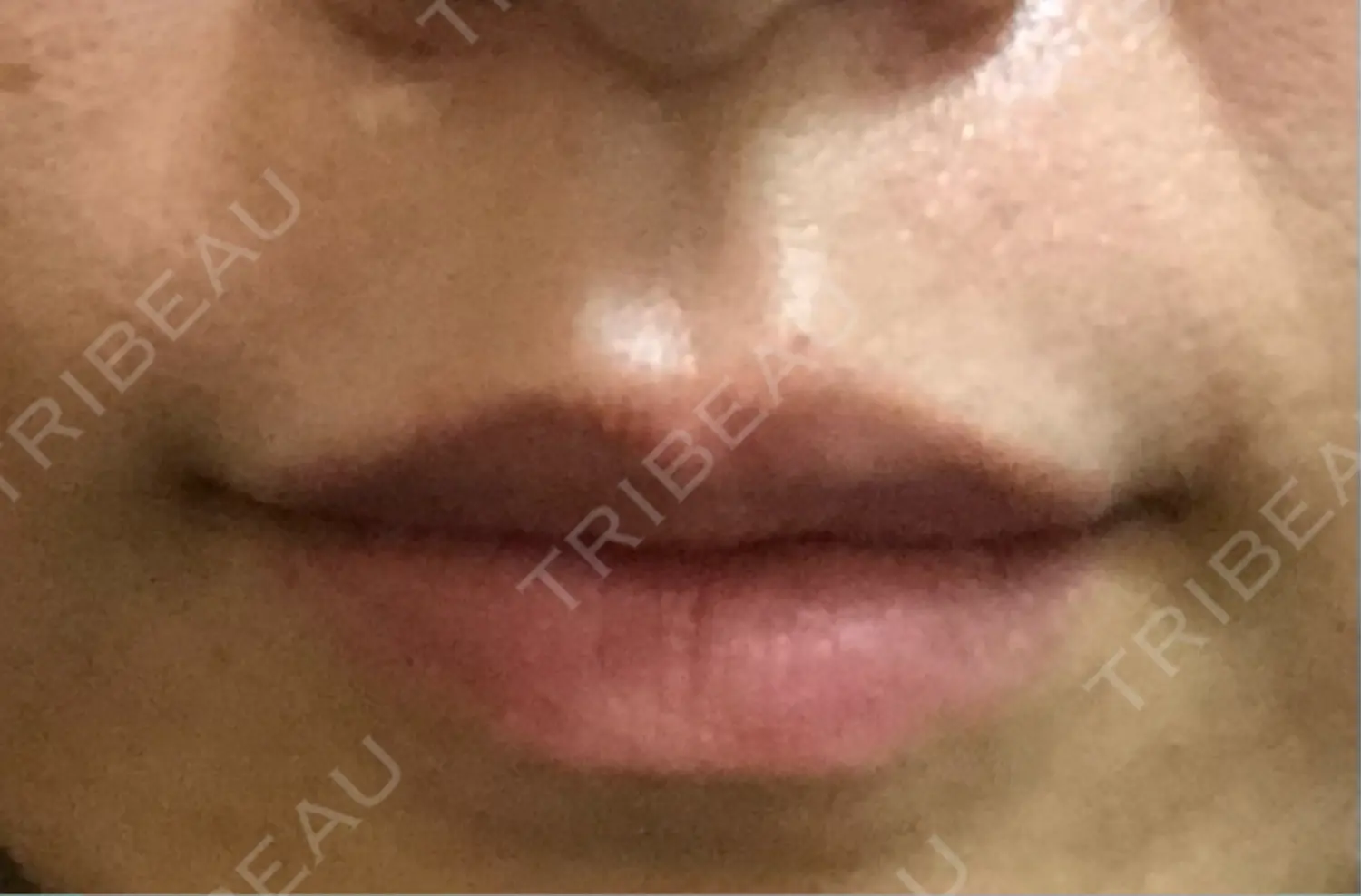 施術後の写真