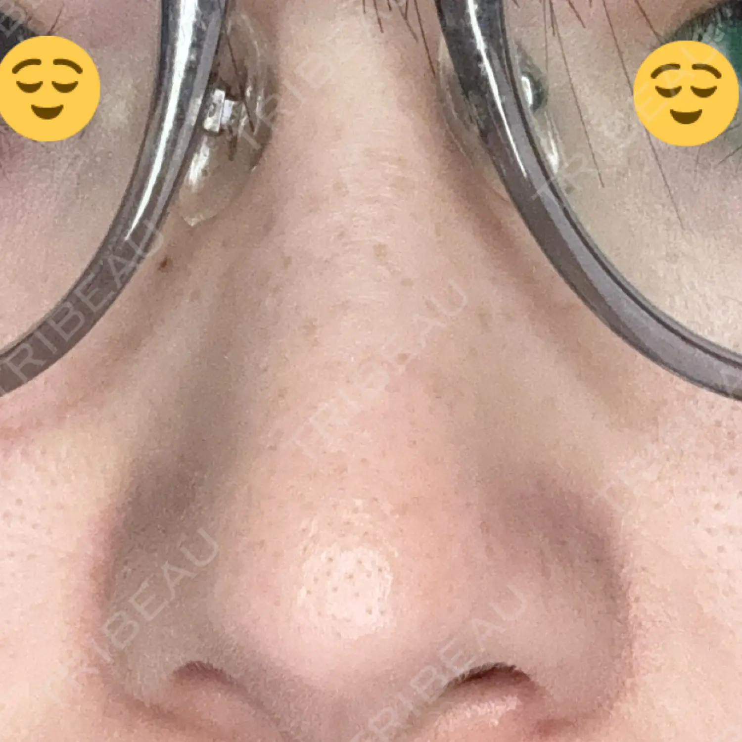 施術後の写真