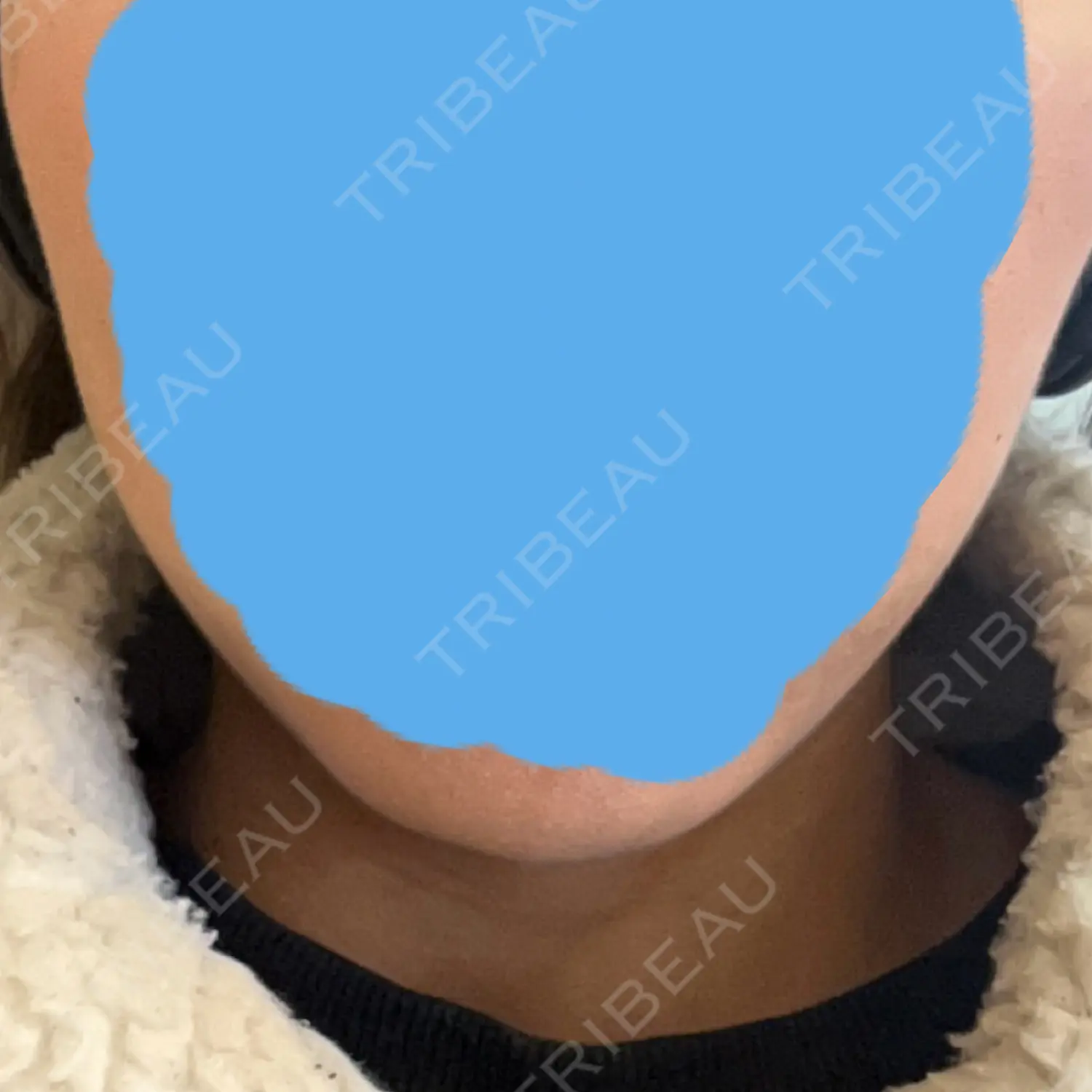 施術後の写真