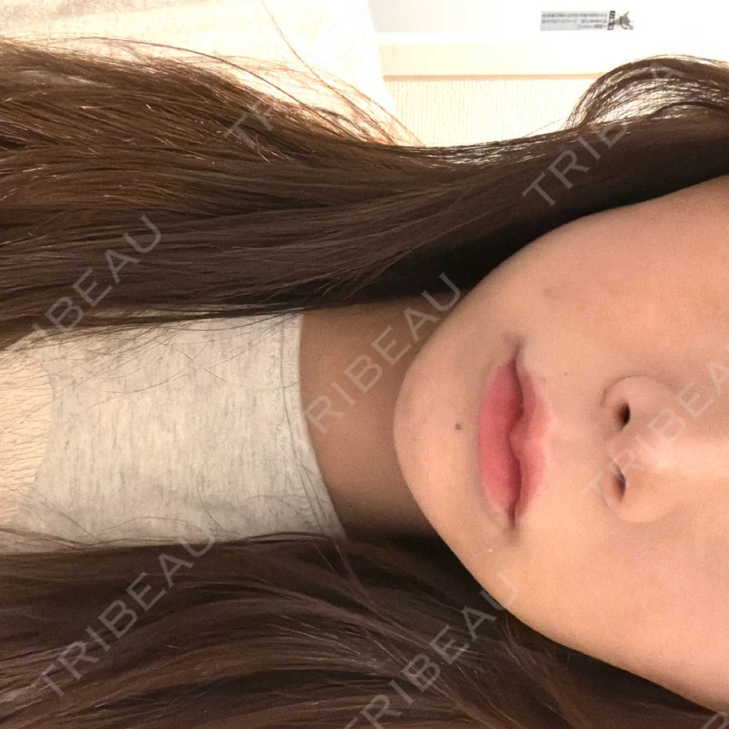 施術後の写真